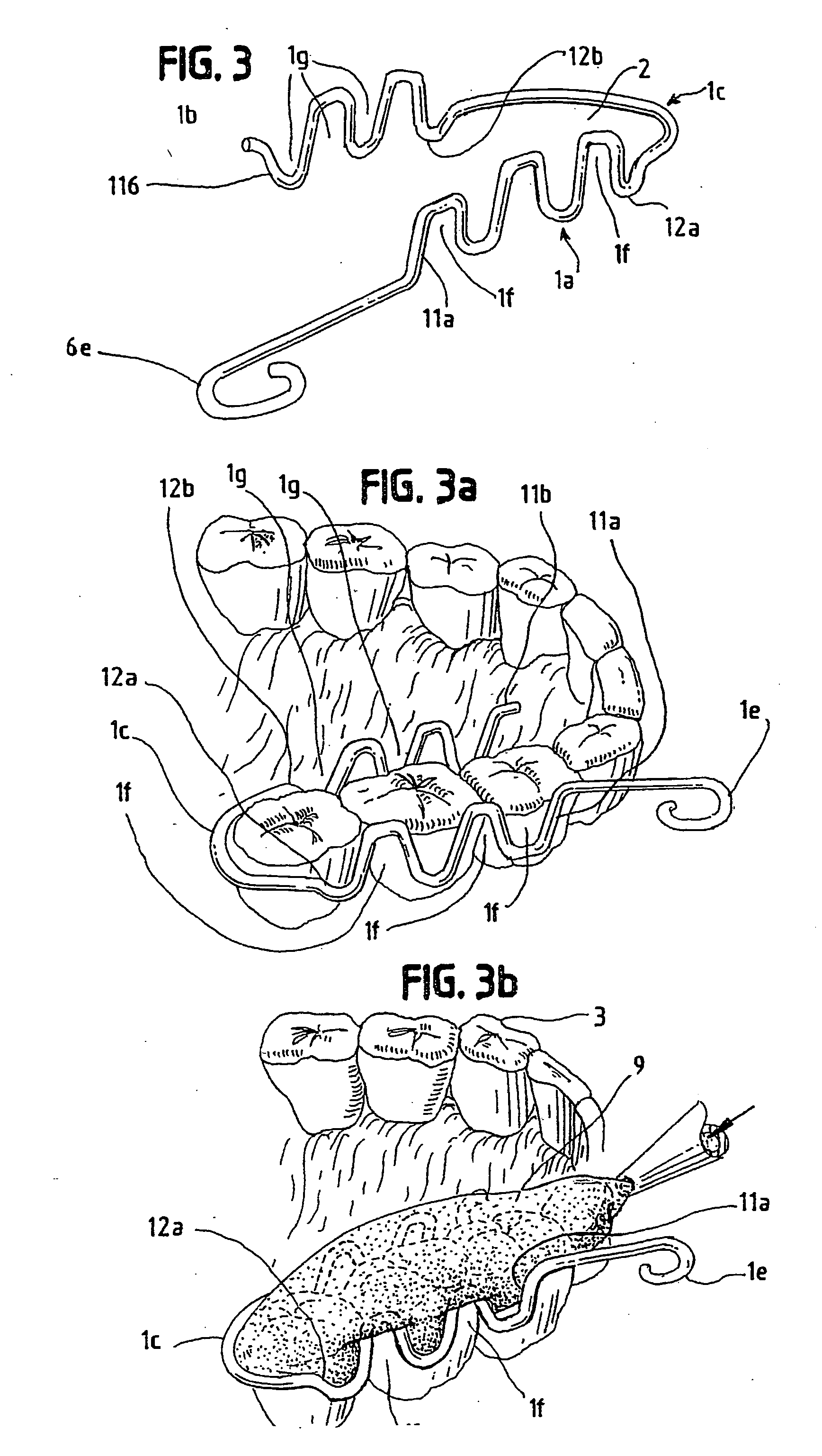 Dental impression method and device