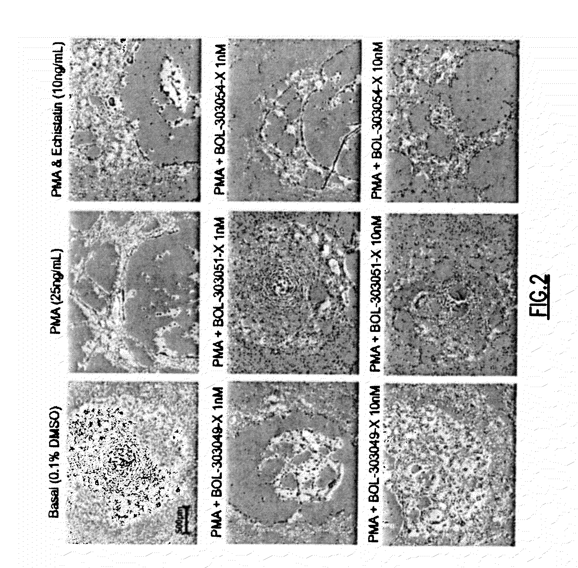 Compositions and methods for treating, reducing, ameliorating, alleviating, or inhibiting progression of, pathogenic ocular neovascularization