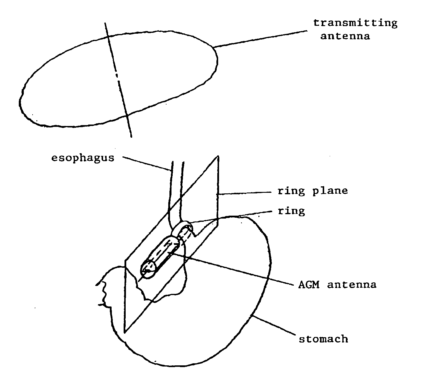 Motor-Operated Gastric Banding Device Or Gastric Ring Comprising At Least One Misaligned Receiving Antenna For Power Supply, Remote Control And Data Transmission By Means Of Induction