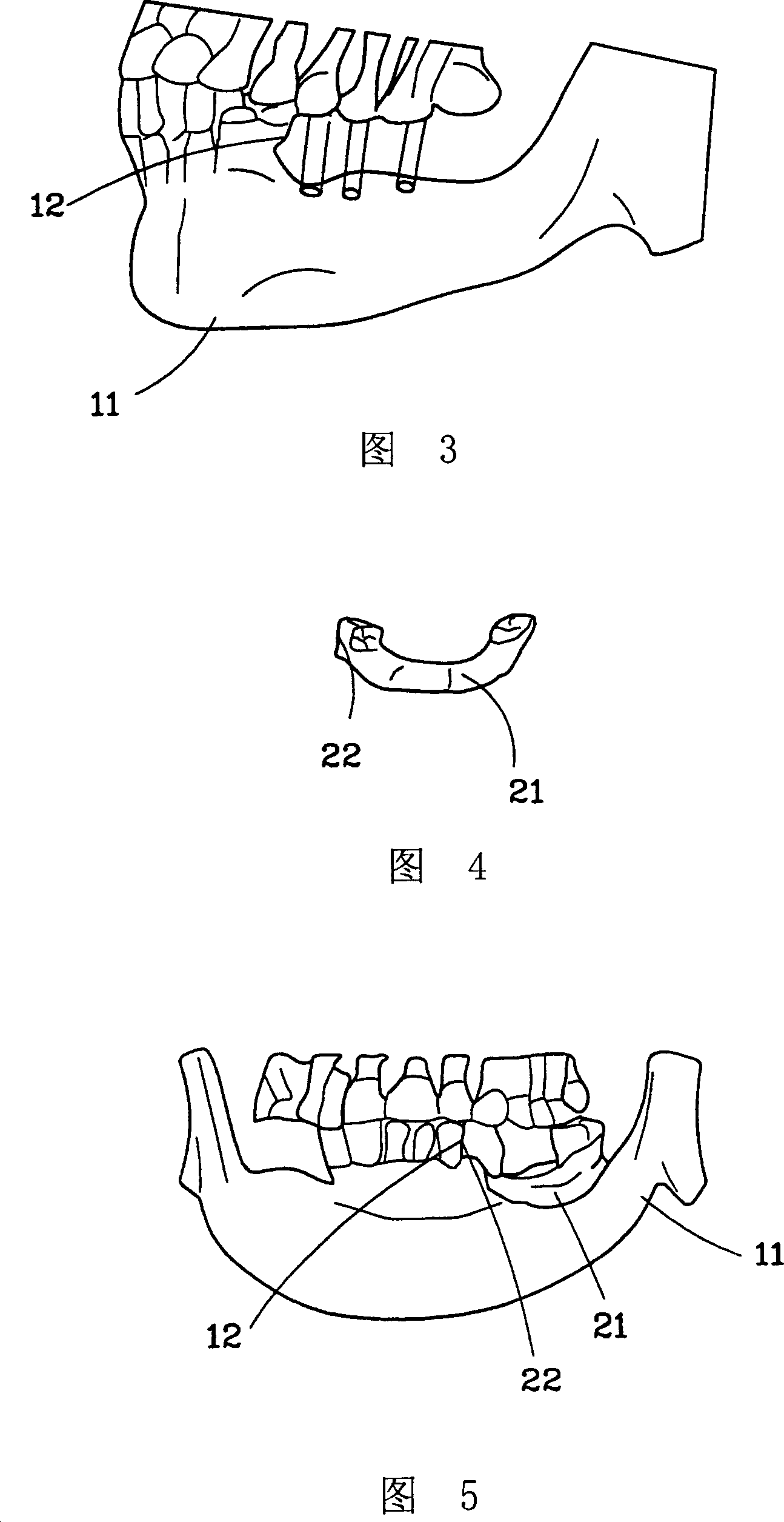 Method for making dental implant