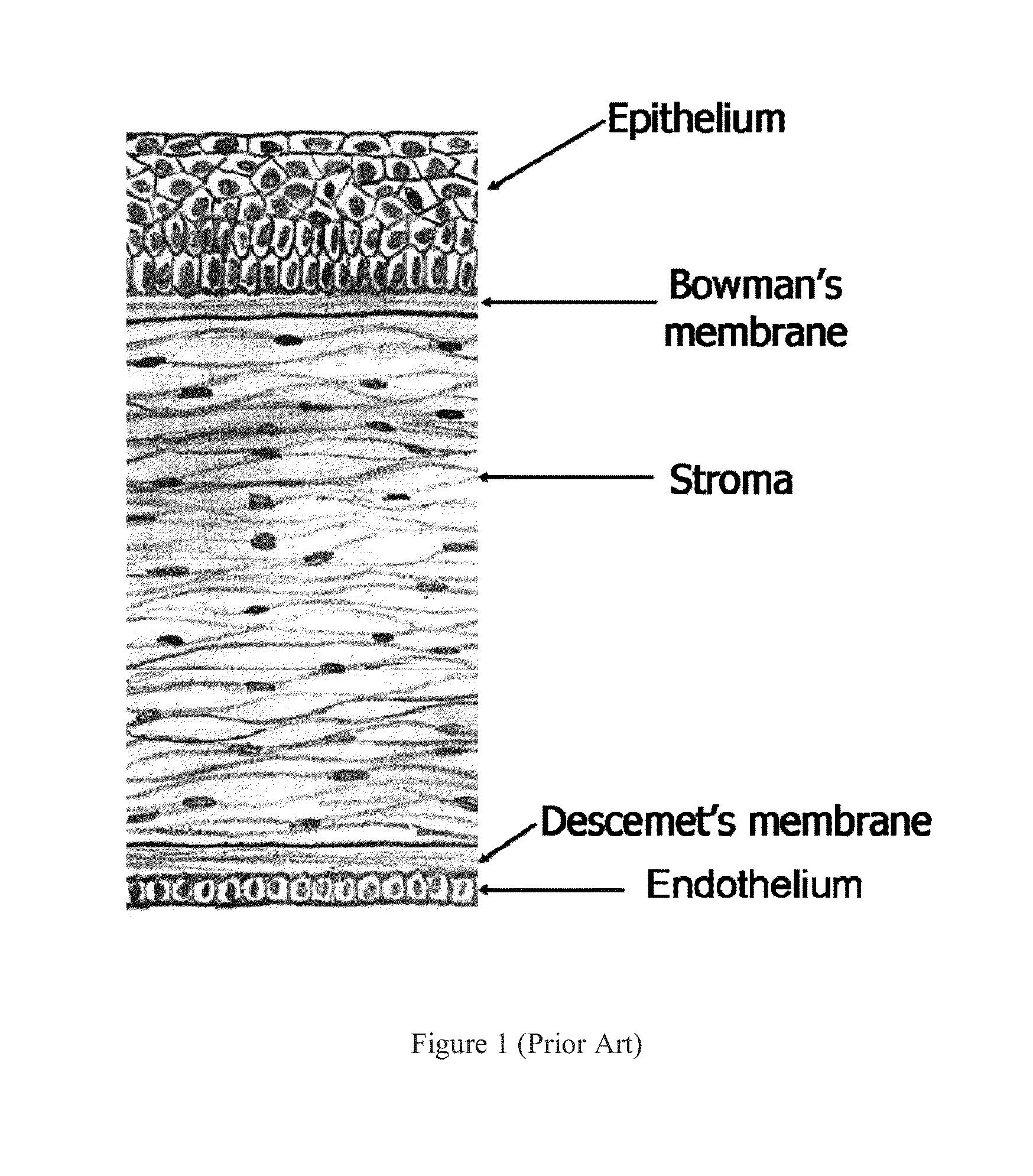 Methods and Systems to Measure Corneal Epithelial Thickness and Power, Stromal Thickness, Subepithelial Corneal Power and Topography for Disease Diagnosis