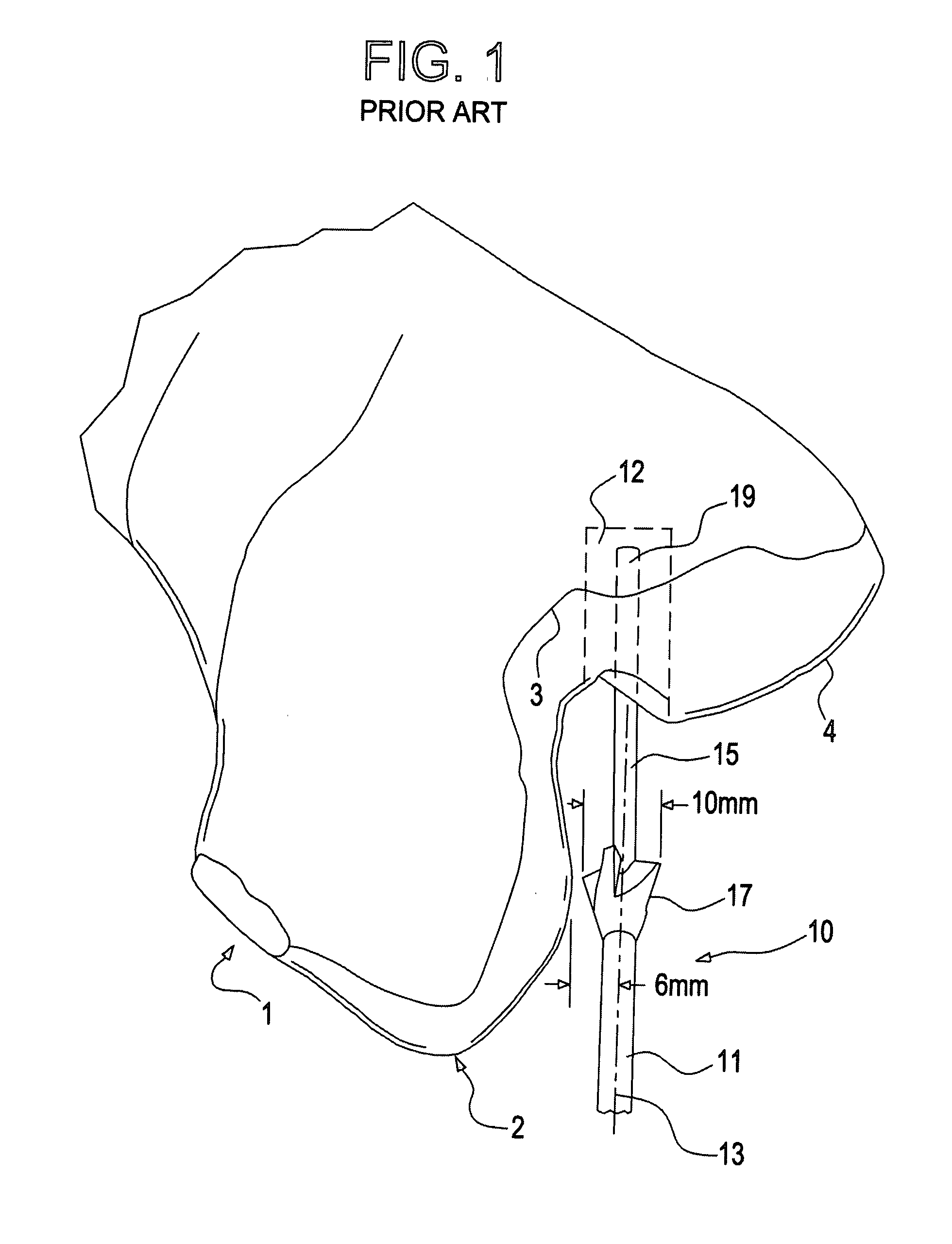 Cannulated drill bit with radially offset cutting edge