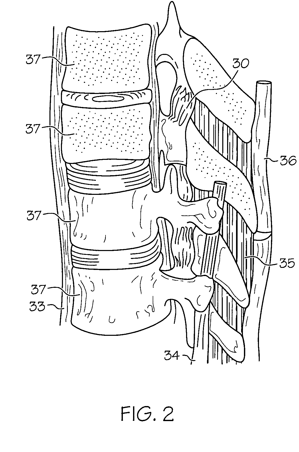 Paddle-style medical lead and method