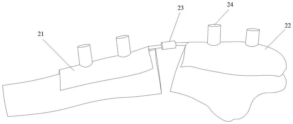 Proximal Ulnar Osteotomy Orthopedic Guide System