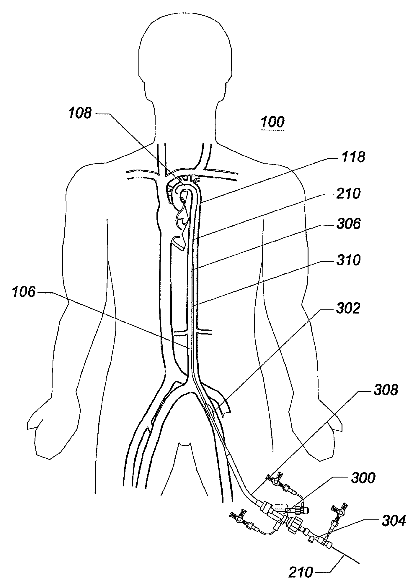 Expandable intra-aortic balloon pump sheath - Eureka | Patsnap