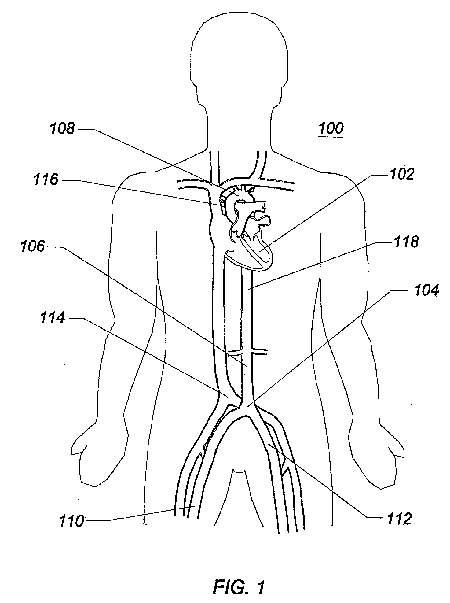 Expandable intra-aortic balloon pump sheath