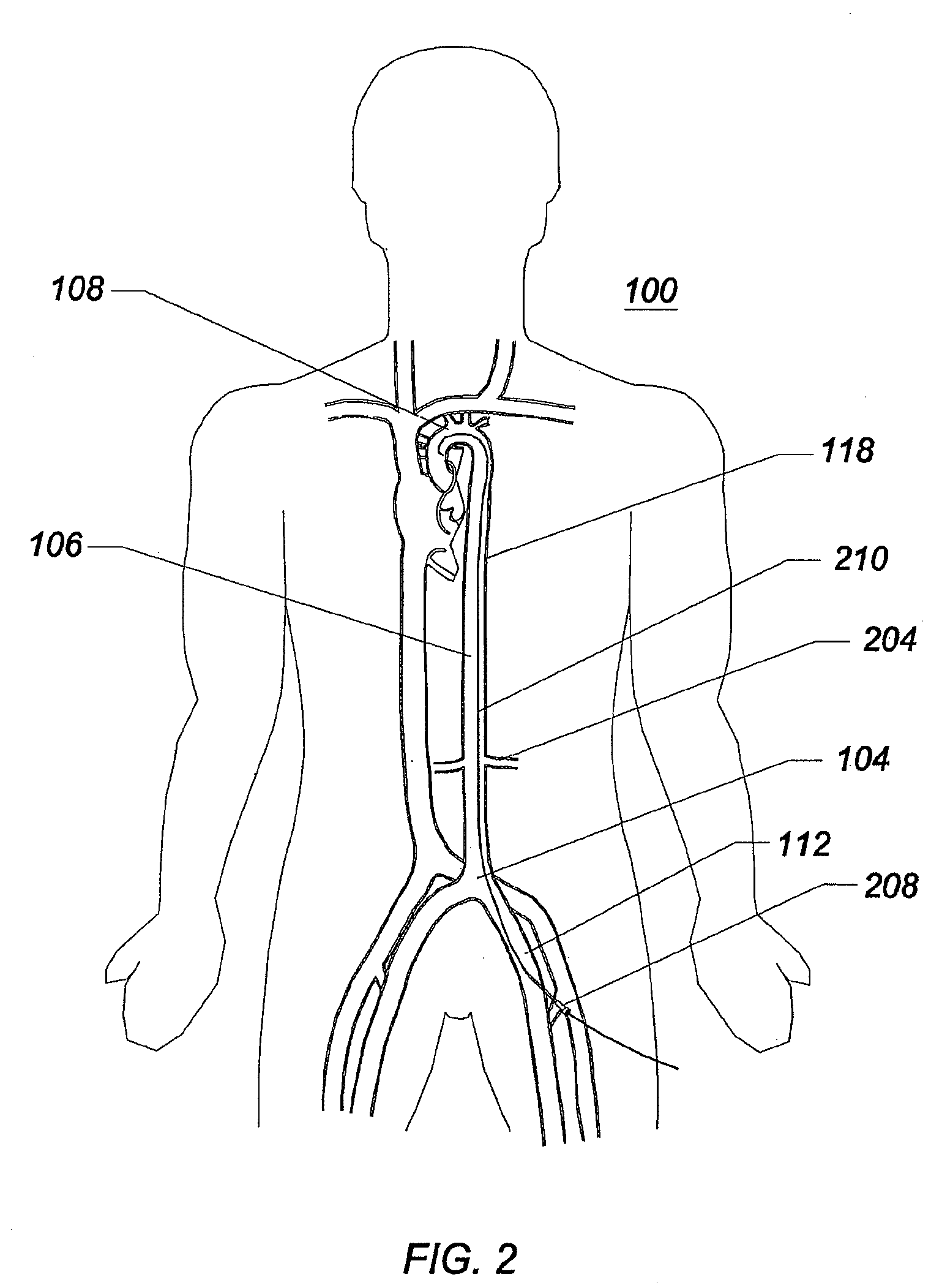 Expandable intra-aortic balloon pump sheath