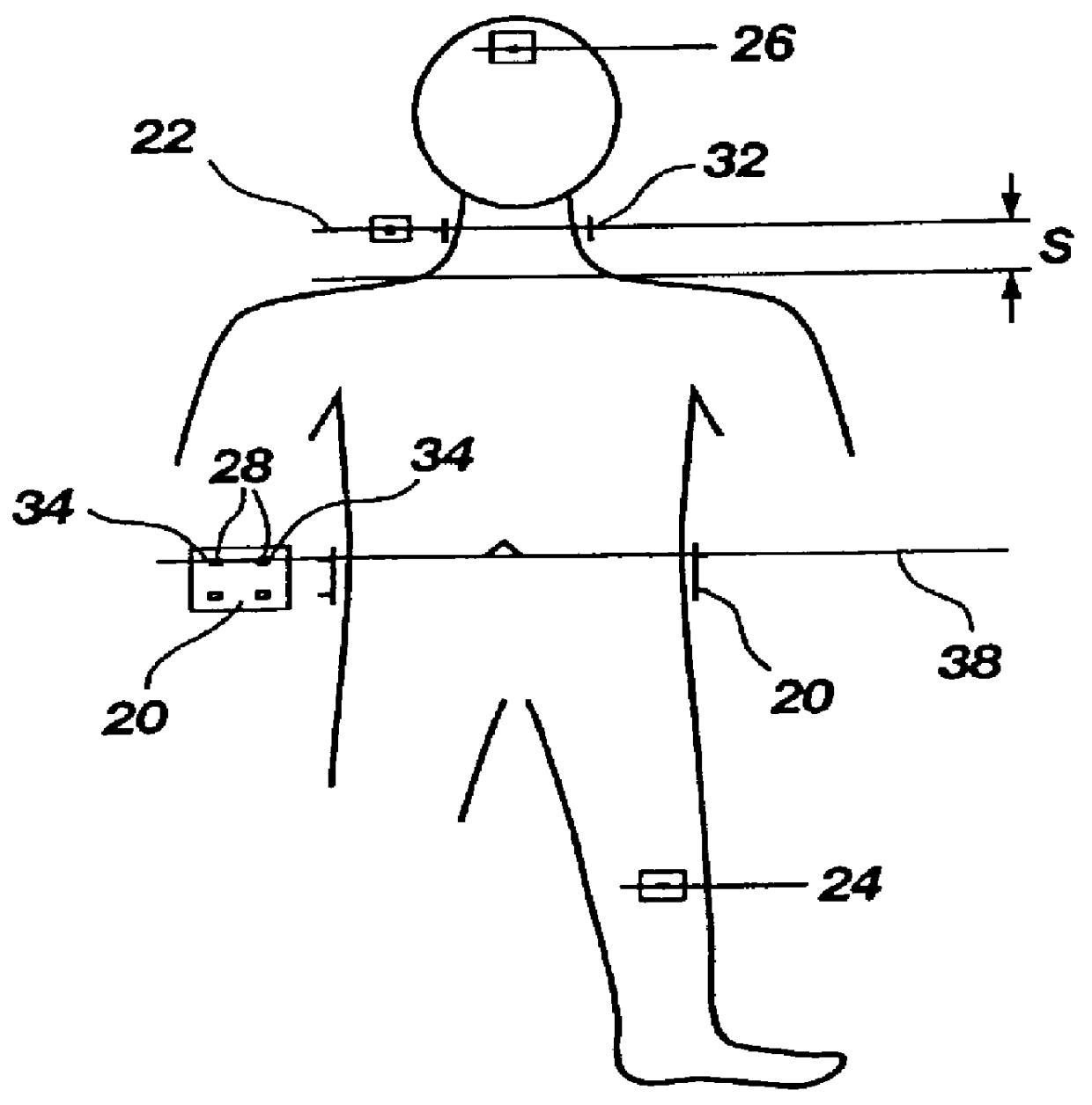 Non-invasive monitoring of hemodynamic parameters using impedance cardiography