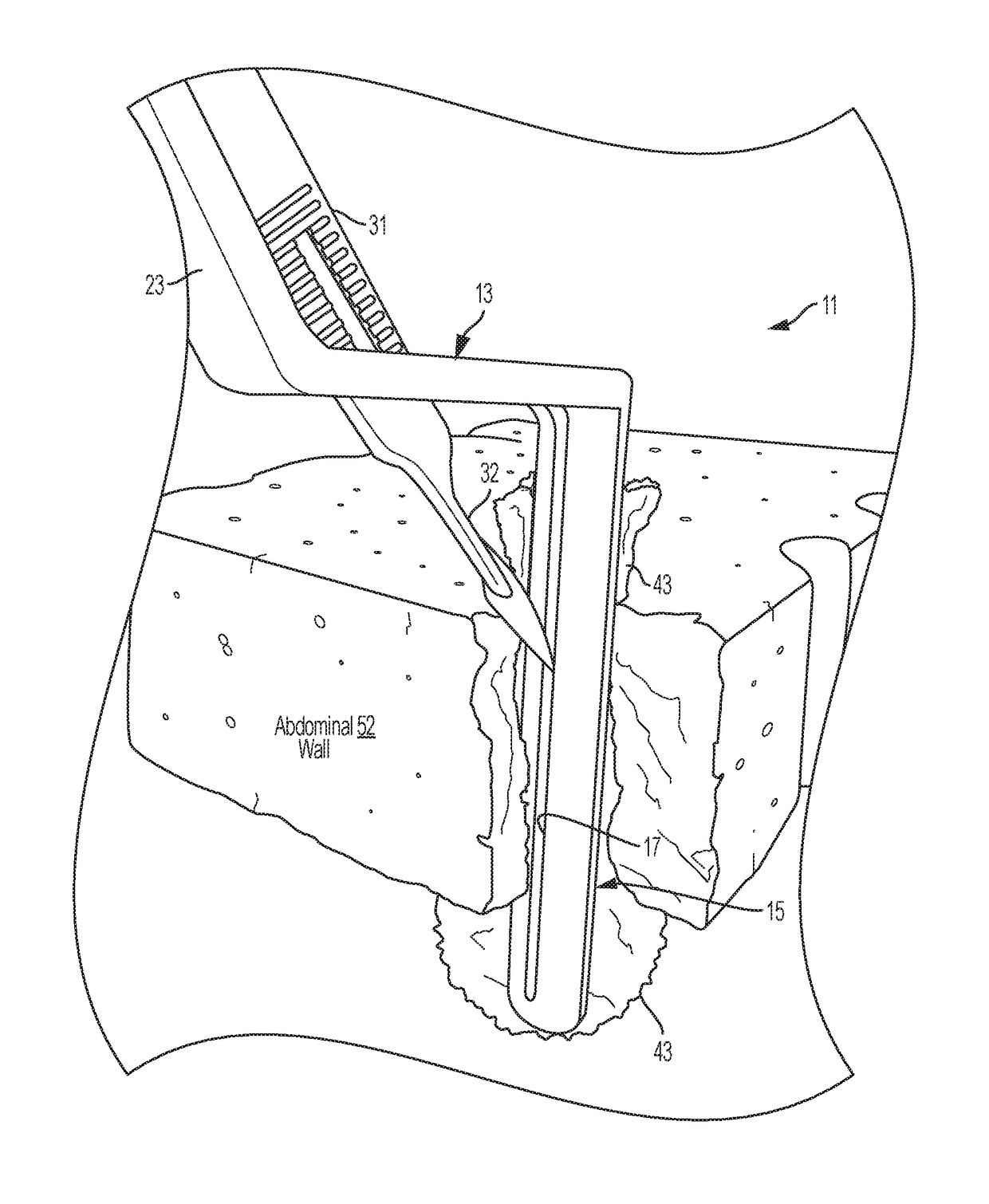 Device and method for safely expanding minimally invasive surgical incisions