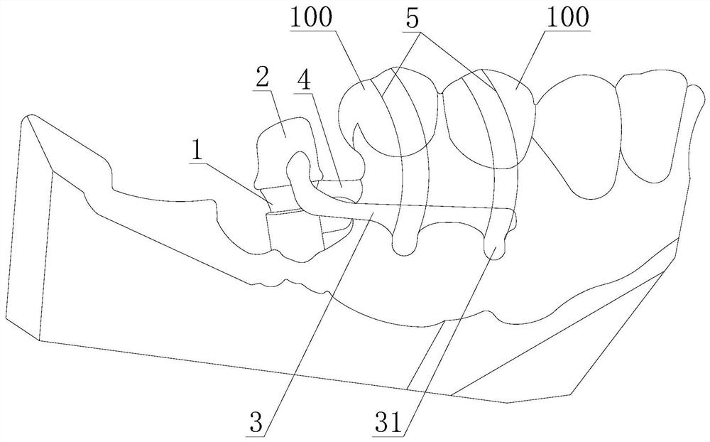 mandibular posterior teeth depression device