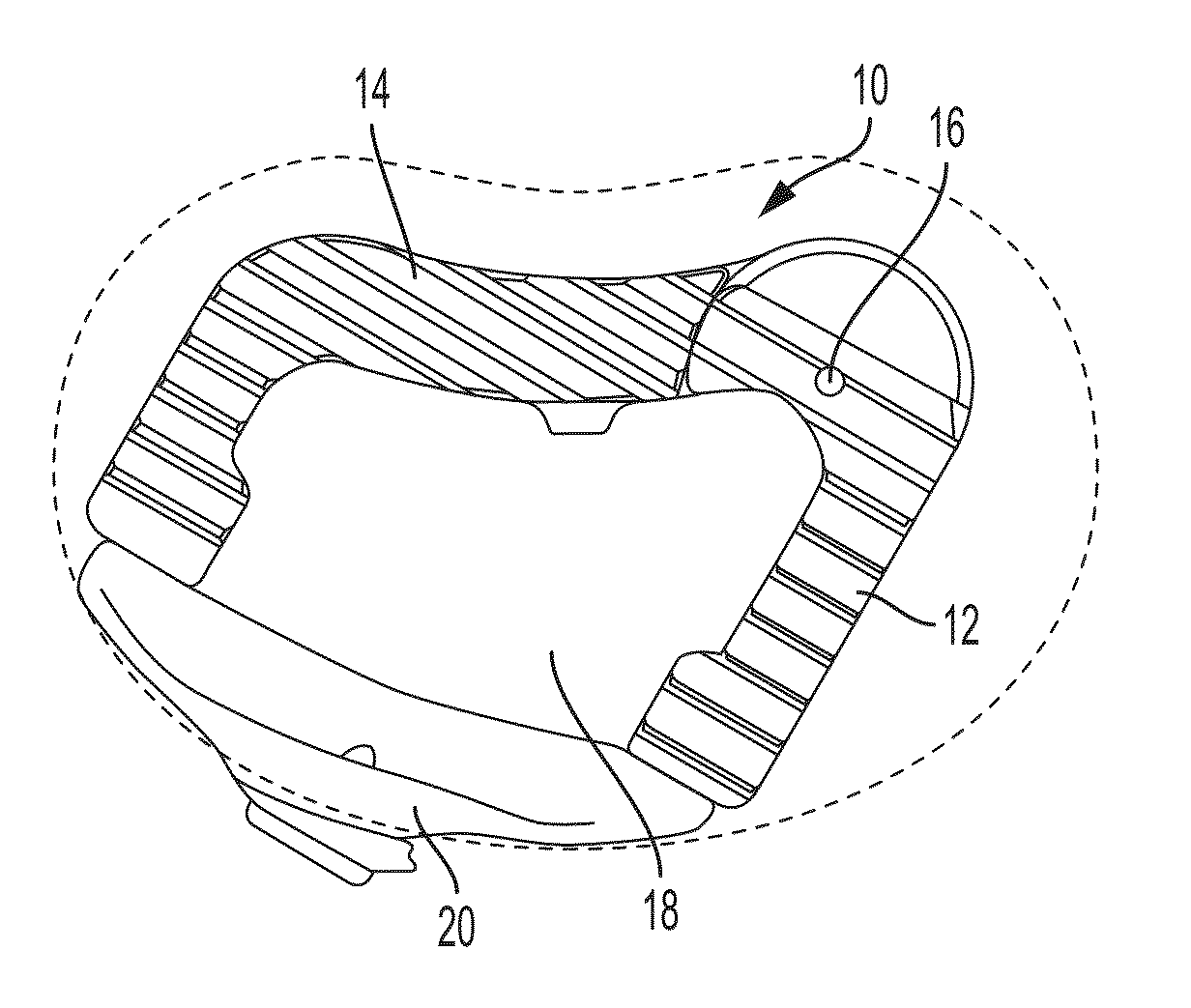 Collapsible two-piece olif implant