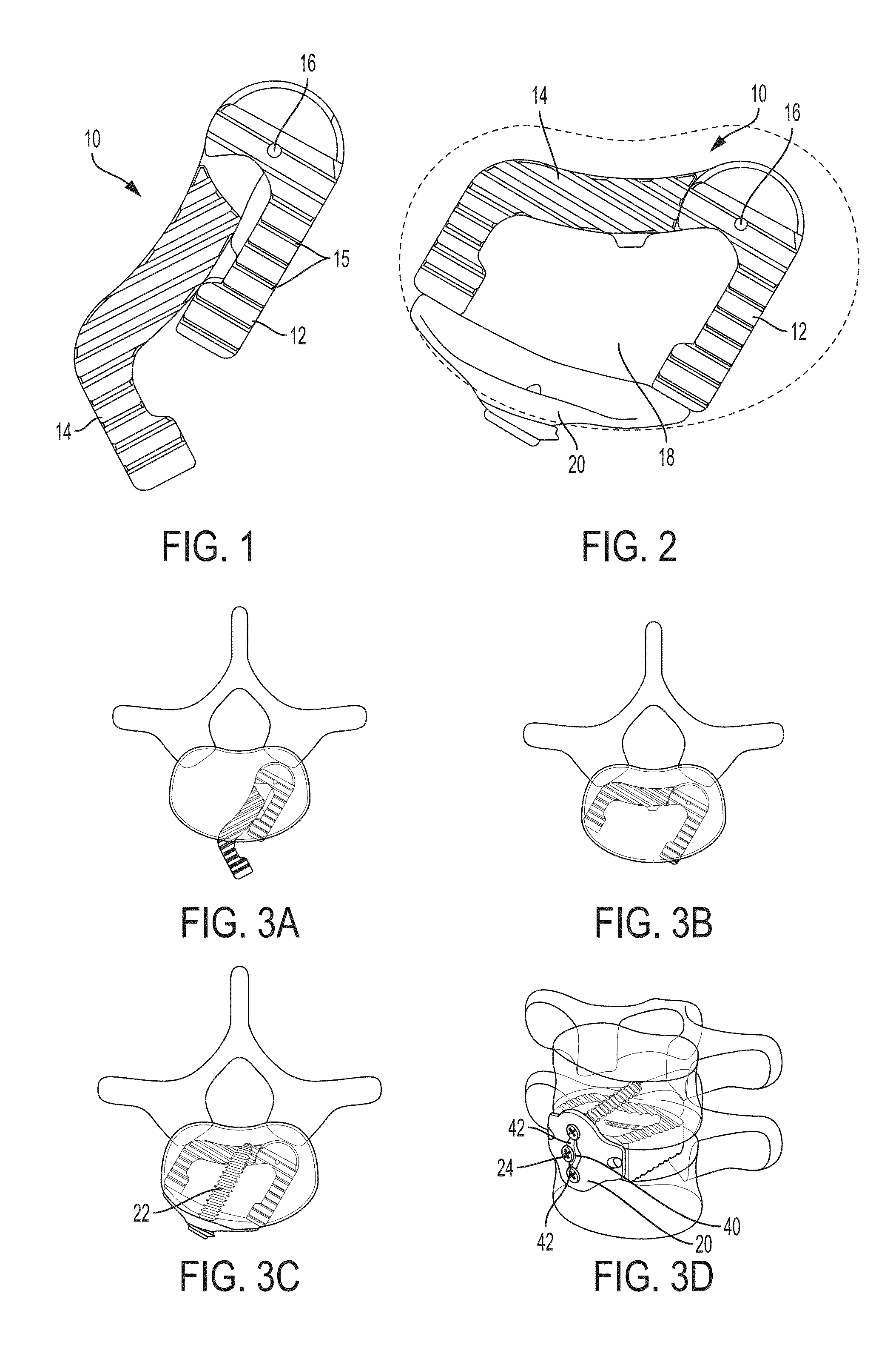 Collapsible two-piece olif implant