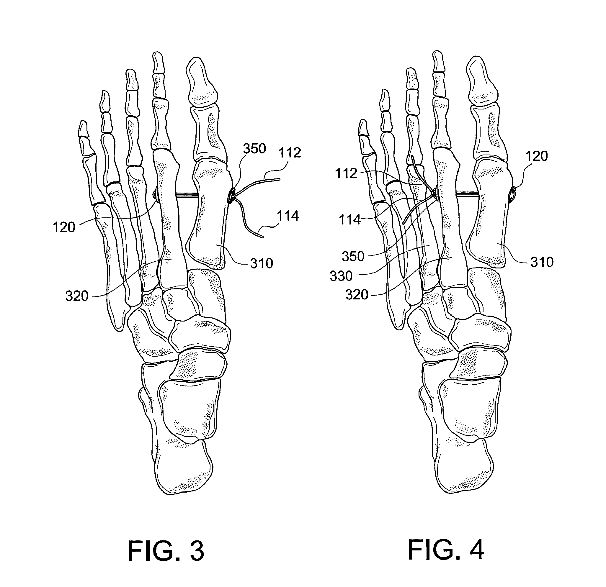 Hallux valgus repairs using suture-button construct