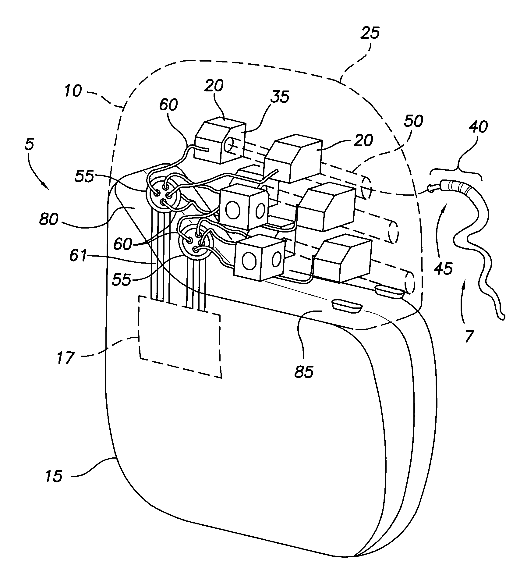 Implantable pulse generator EMI filtered feedthru using discrete capacitors