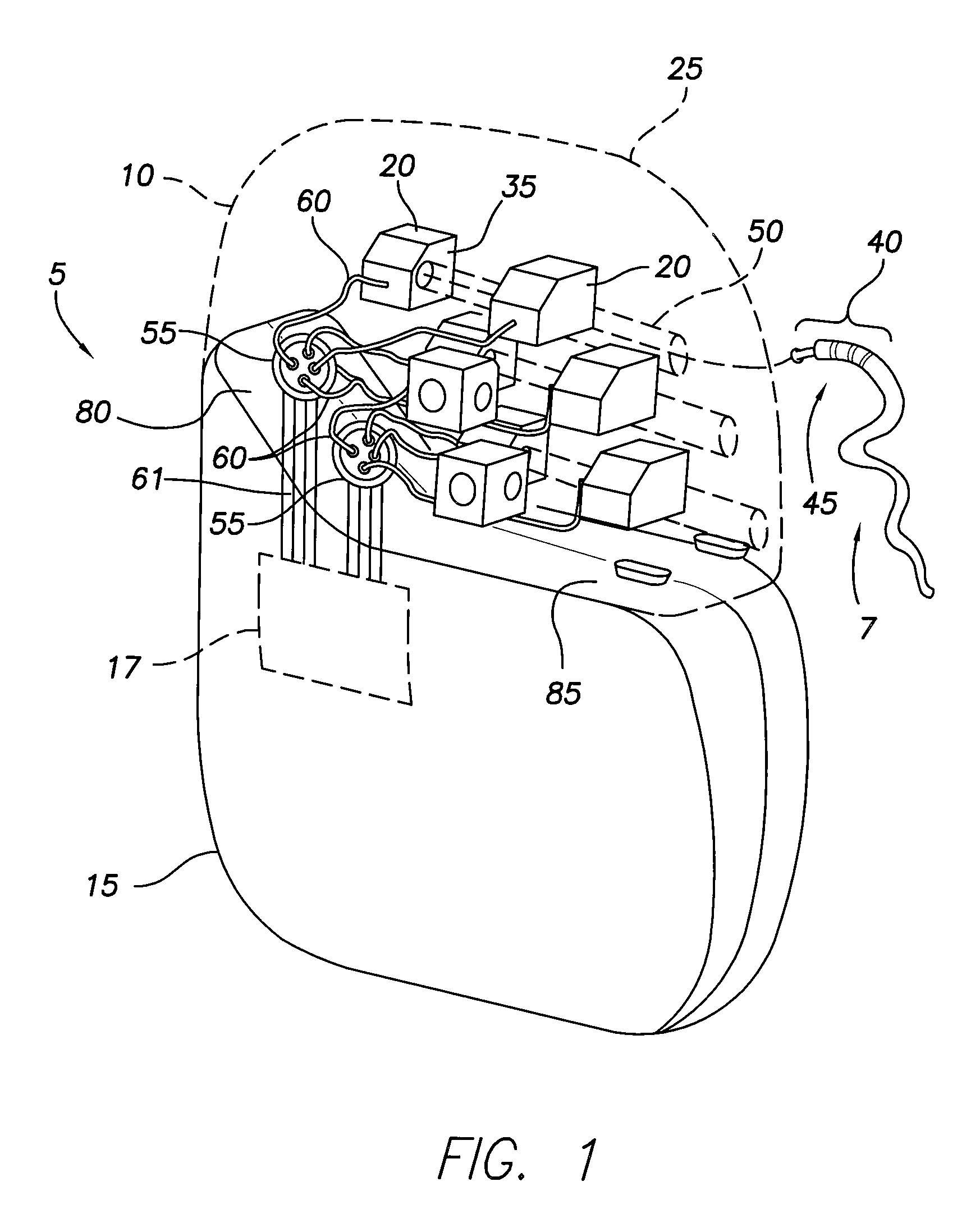 Implantable pulse generator EMI filtered feedthru using discrete capacitors