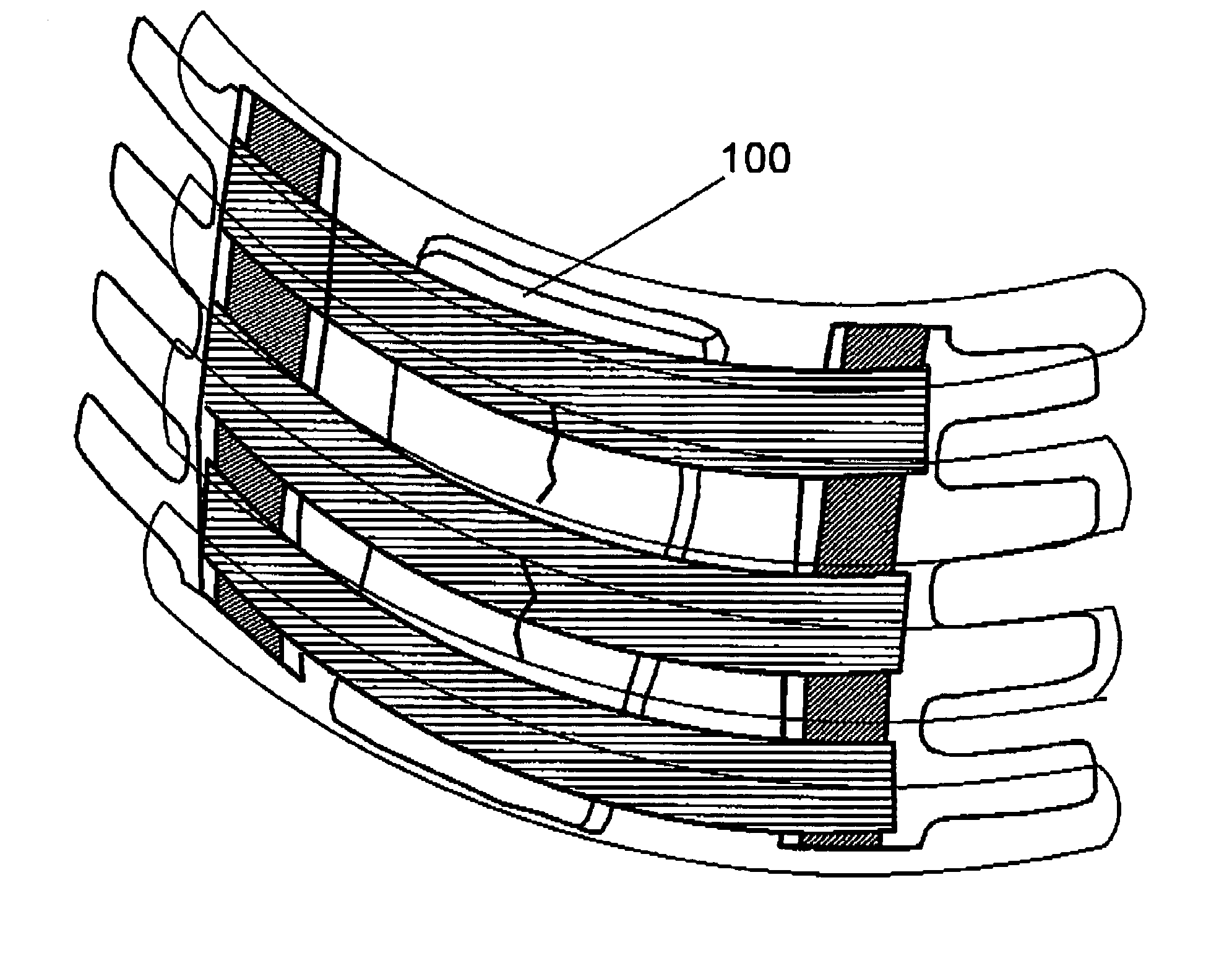 Method for splinting rib injuries