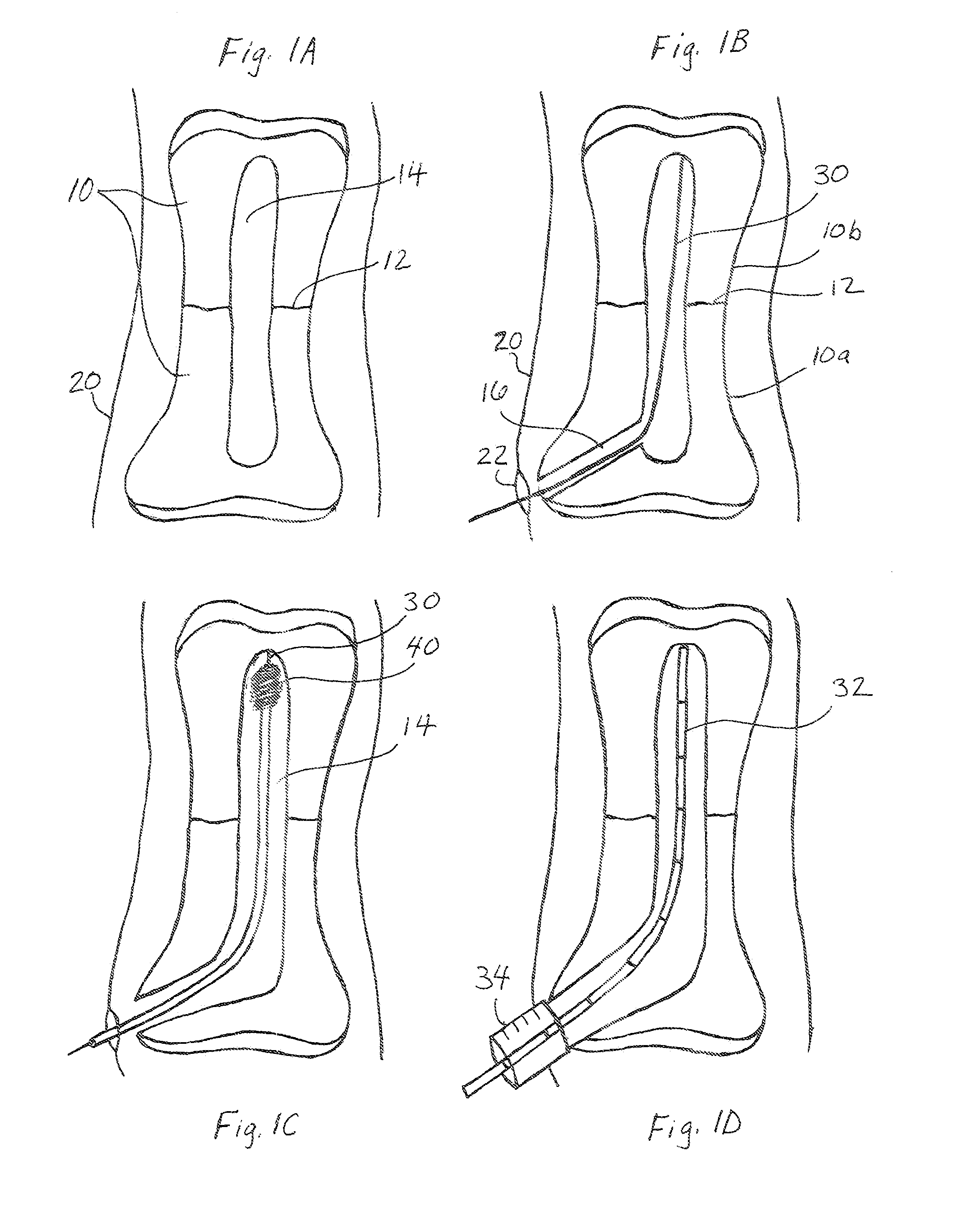 Intramedullary rod fixation system