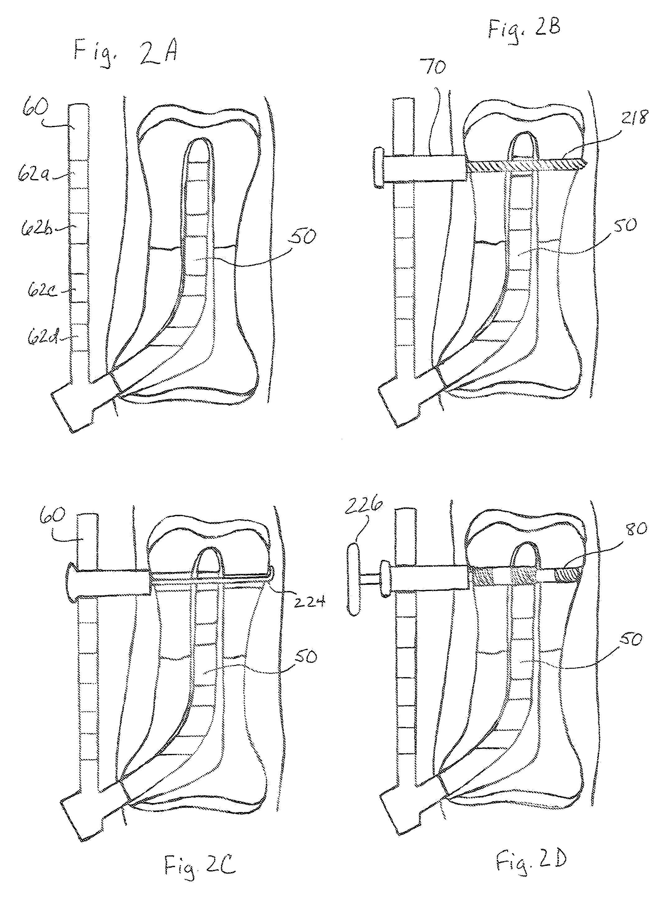 Intramedullary rod fixation system