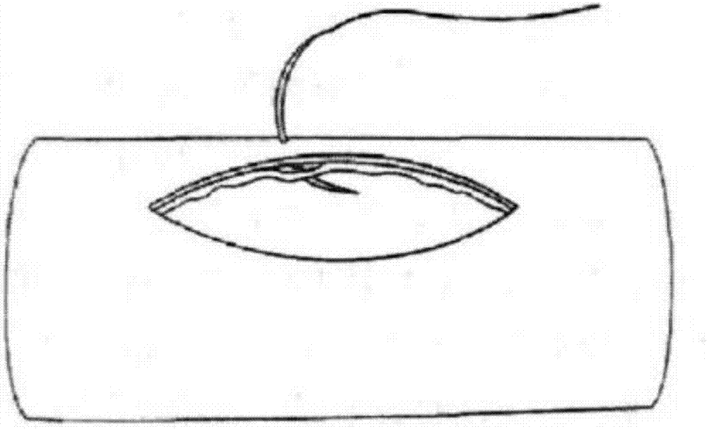 Femoral artery puncture suture device