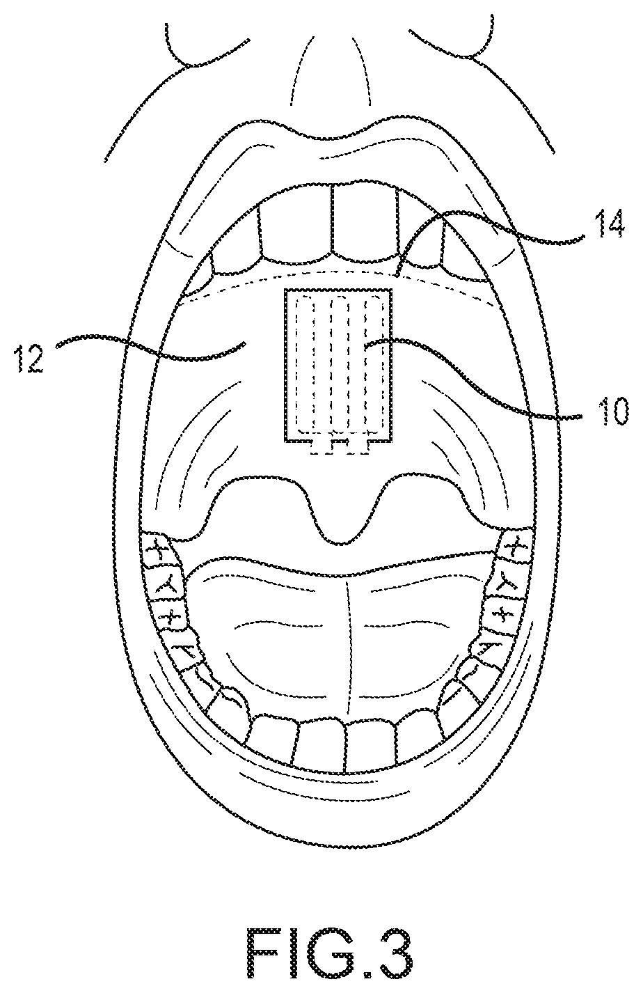 Method and system for preventing sore throat in humans