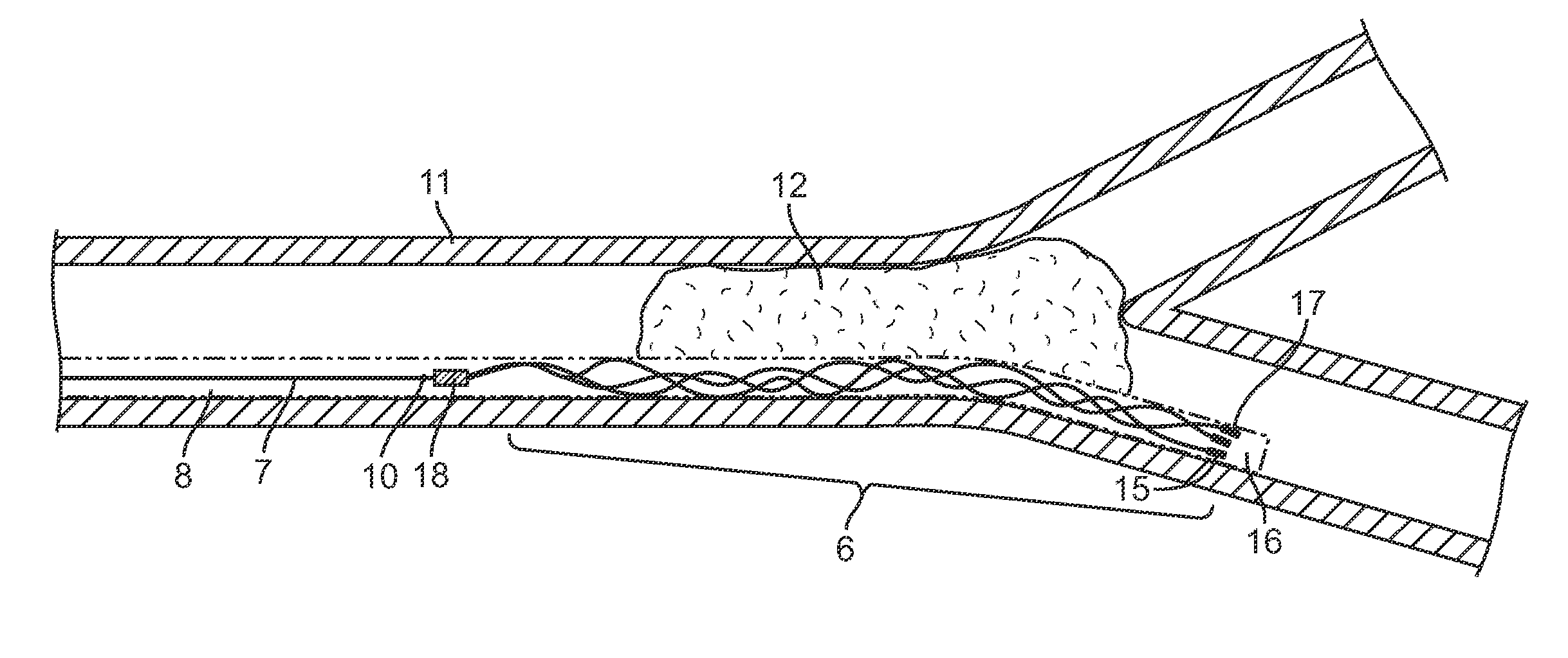 Methods and apparatus for flow restoration