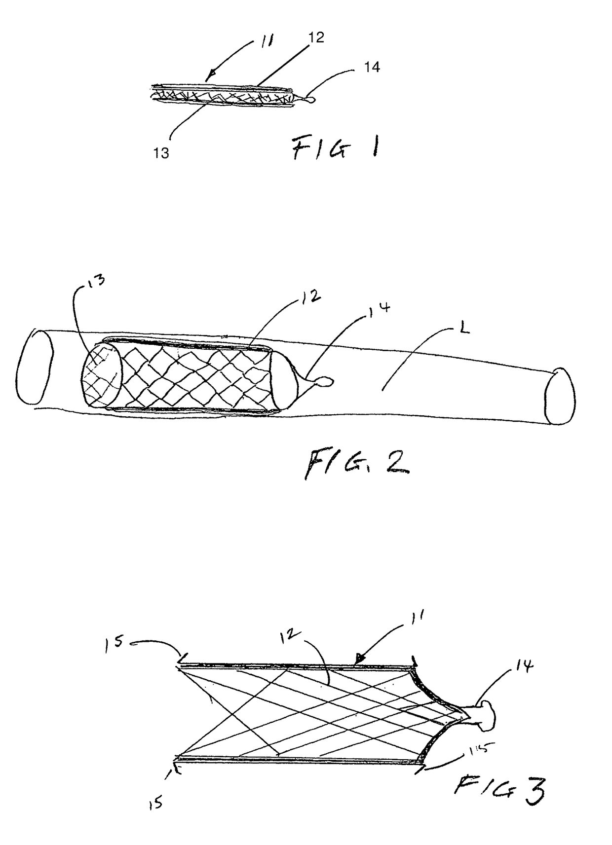 Implantable systems and stents containing cells for therapeutic uses