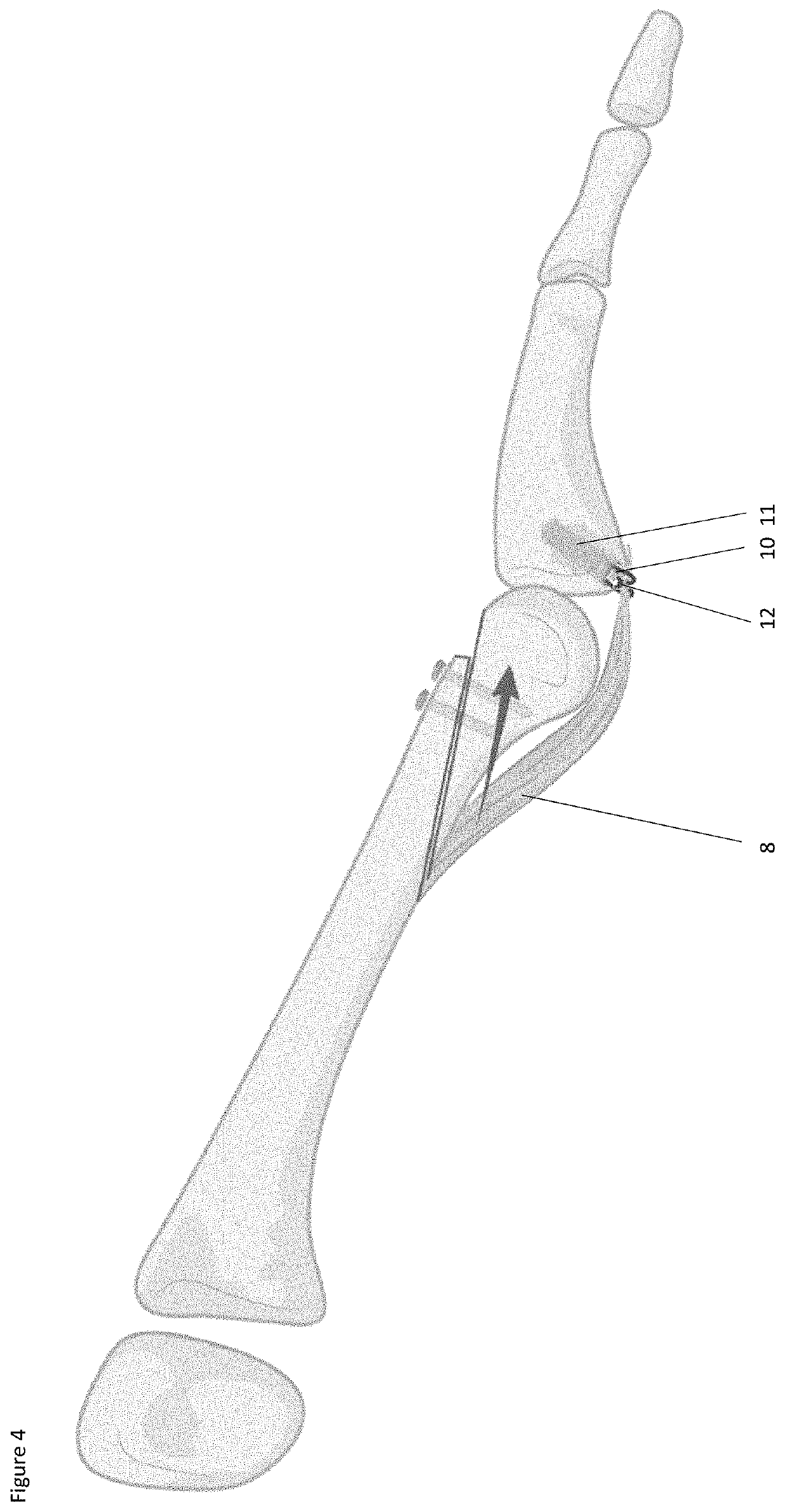 Surgical methods for the treatment of plantar plate injury