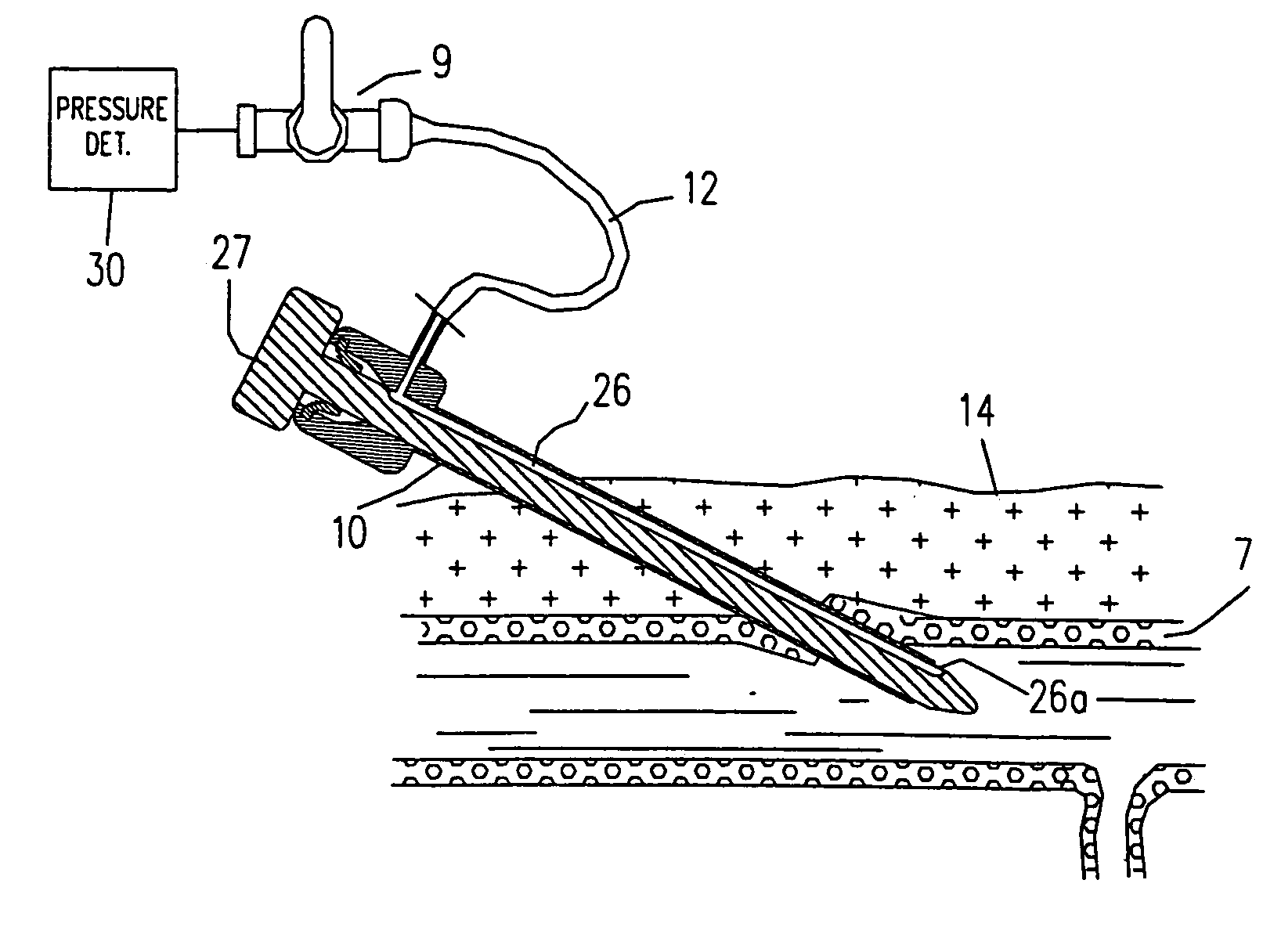 Technique to confirm correct positioning with respect to arterial wall