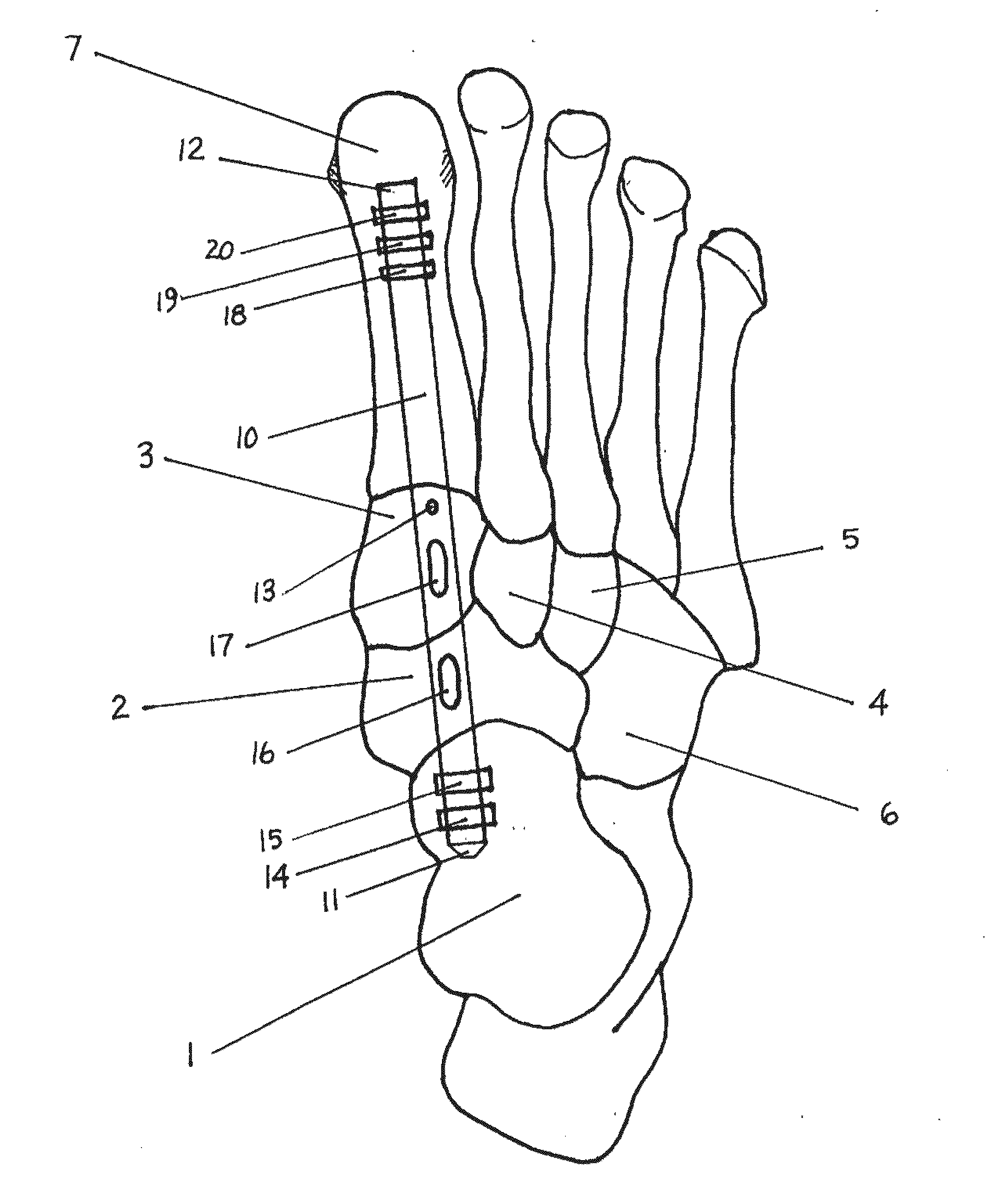 Method and Apparatus for Repairing the Mid-Foot Region Via and Intramedullary Nail