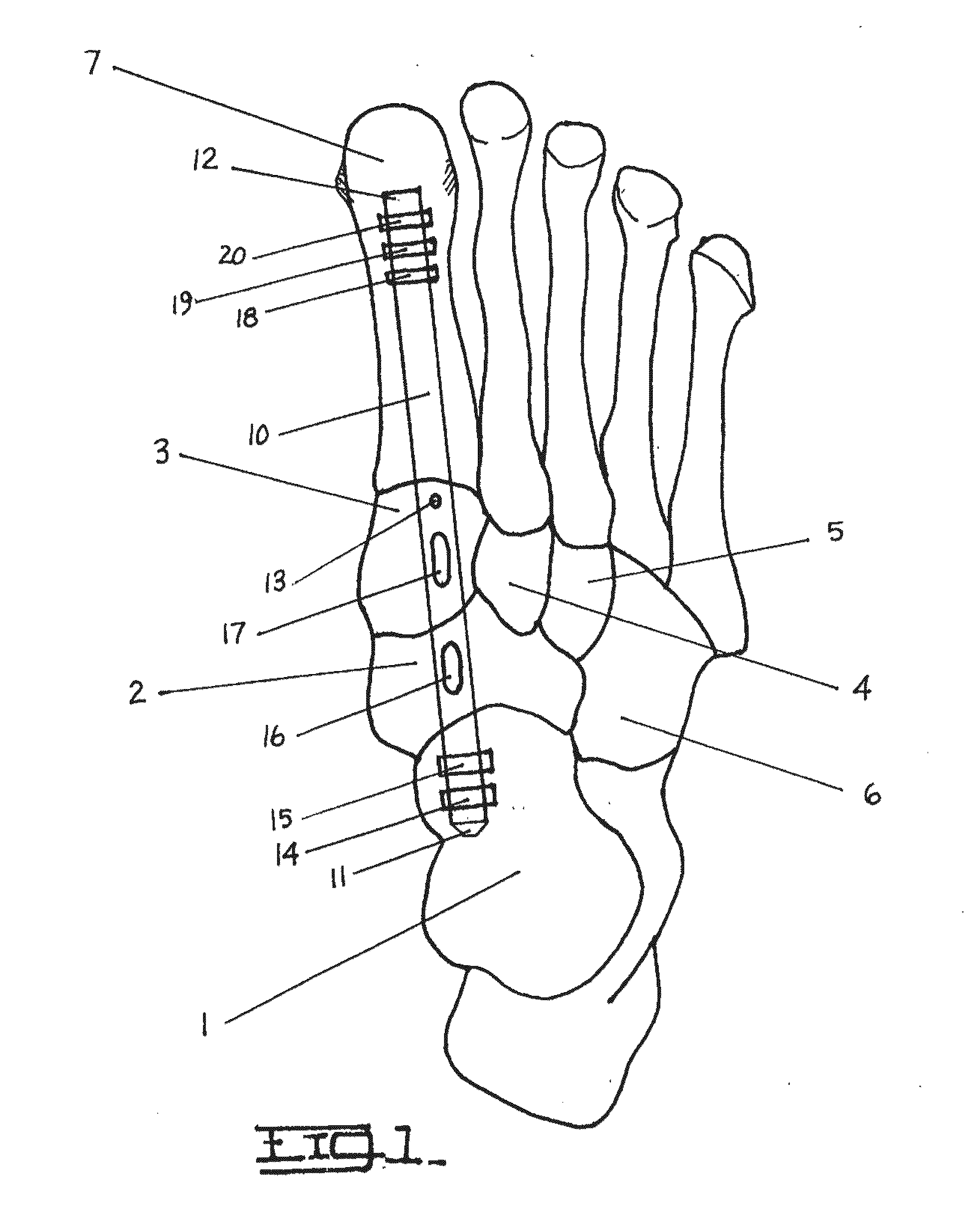 Method and Apparatus for Repairing the Mid-Foot Region Via and Intramedullary Nail