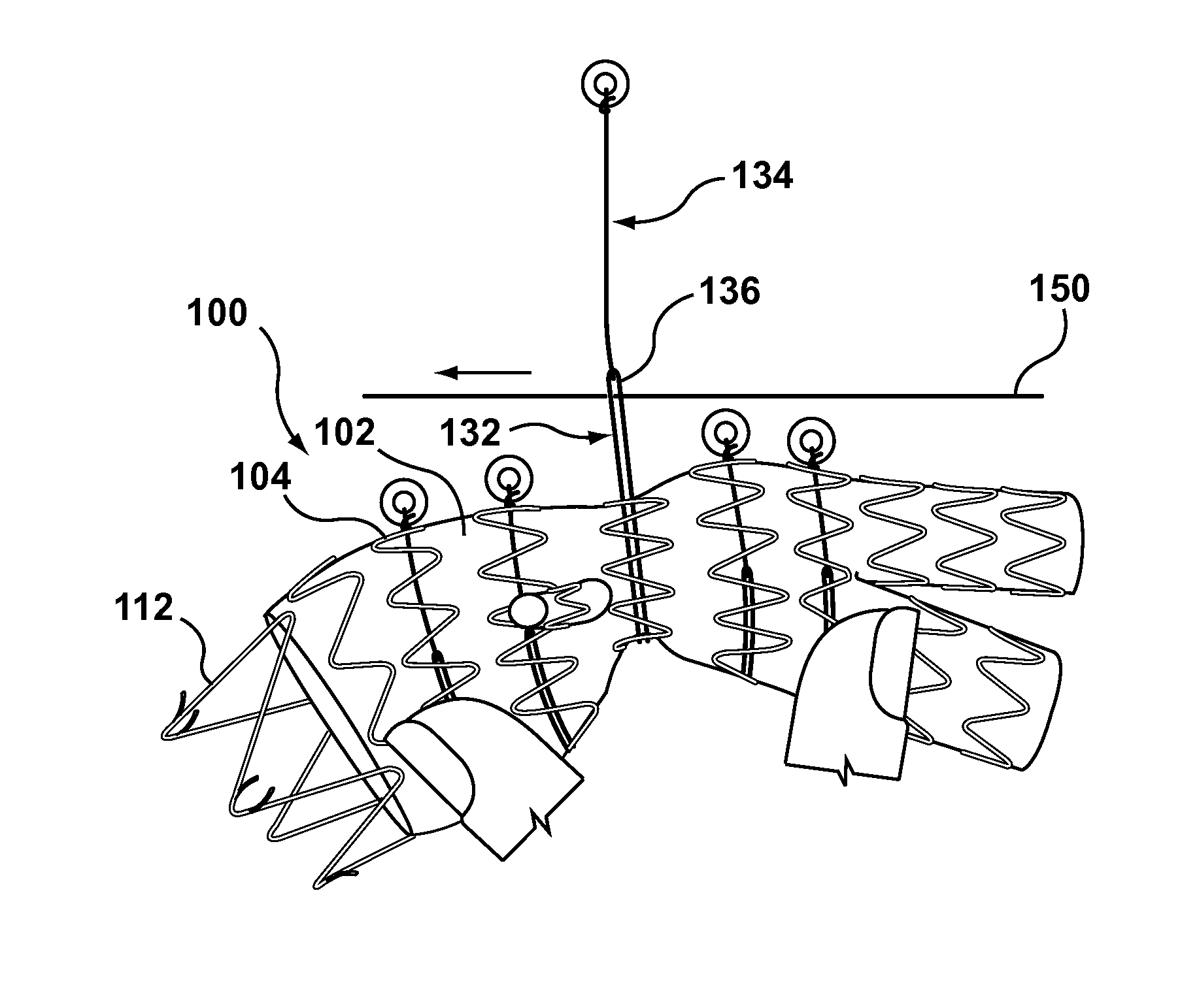 Circumferentially constraining sutures for a stent-graft