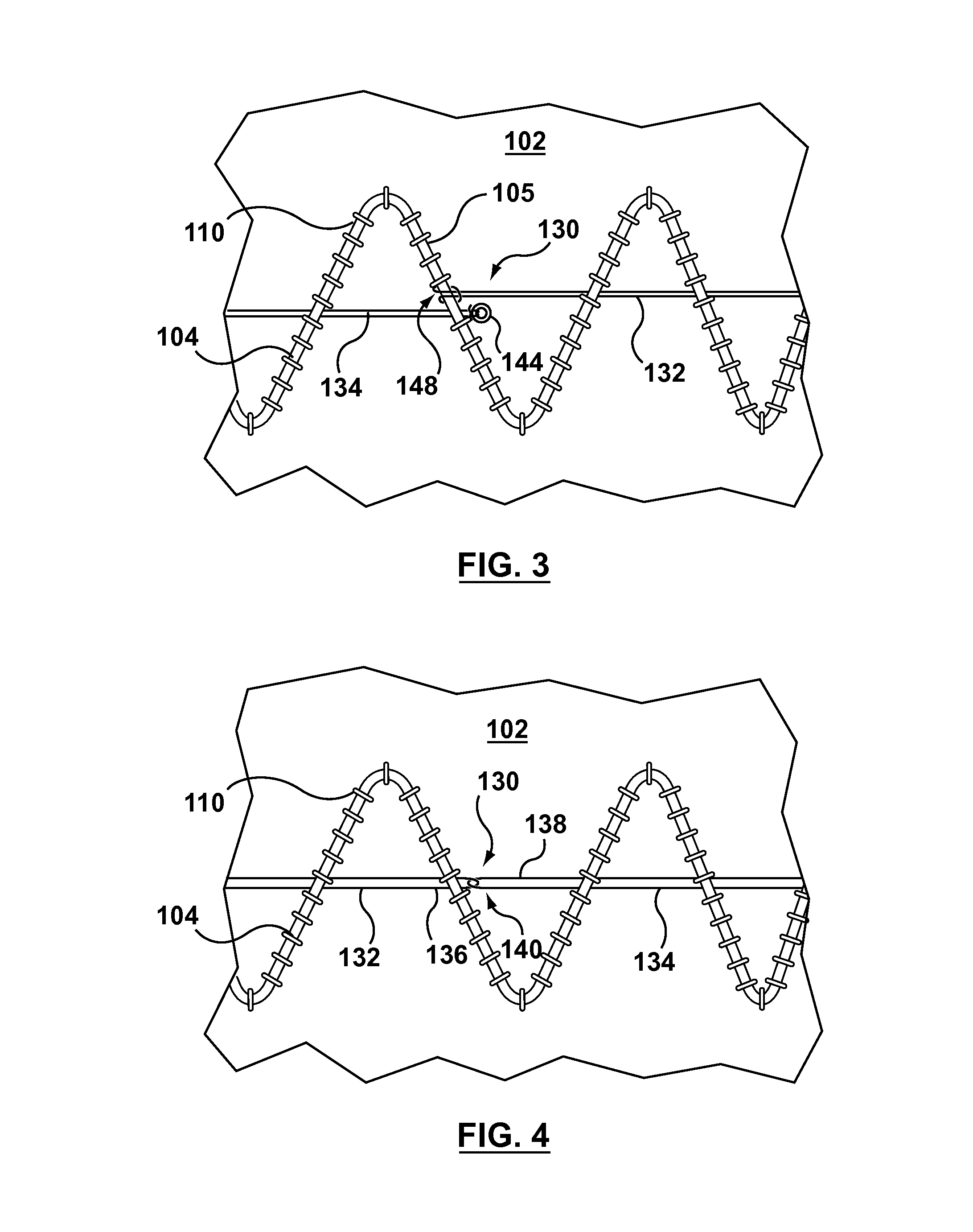 Circumferentially constraining sutures for a stent-graft