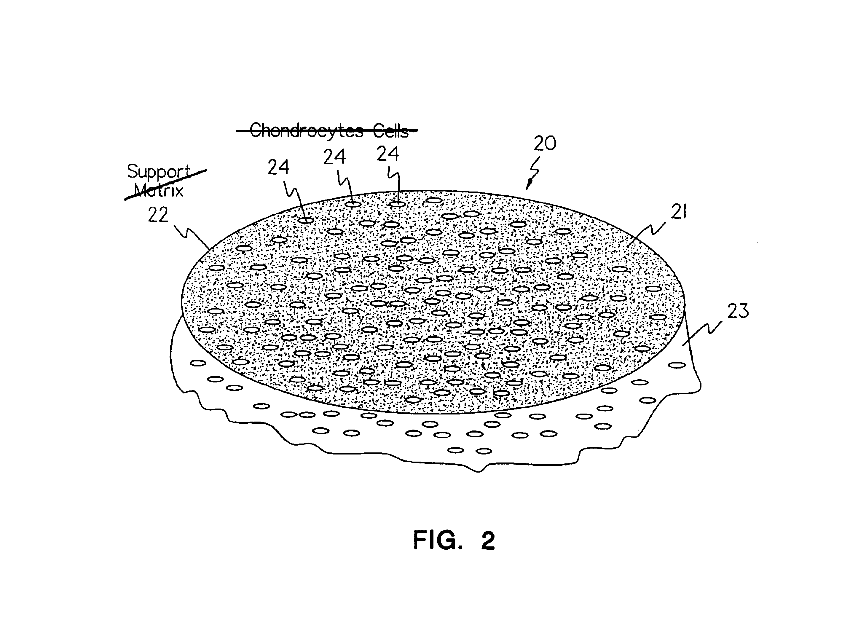 Methods, instruments and materials for chondrocyte cell transplantation