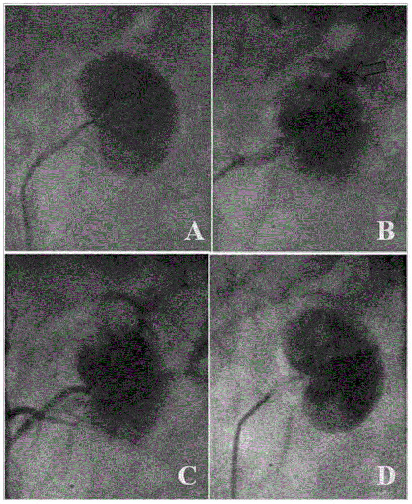 Application of hydrogel microspheres embedded with blood coagulation related enzyme