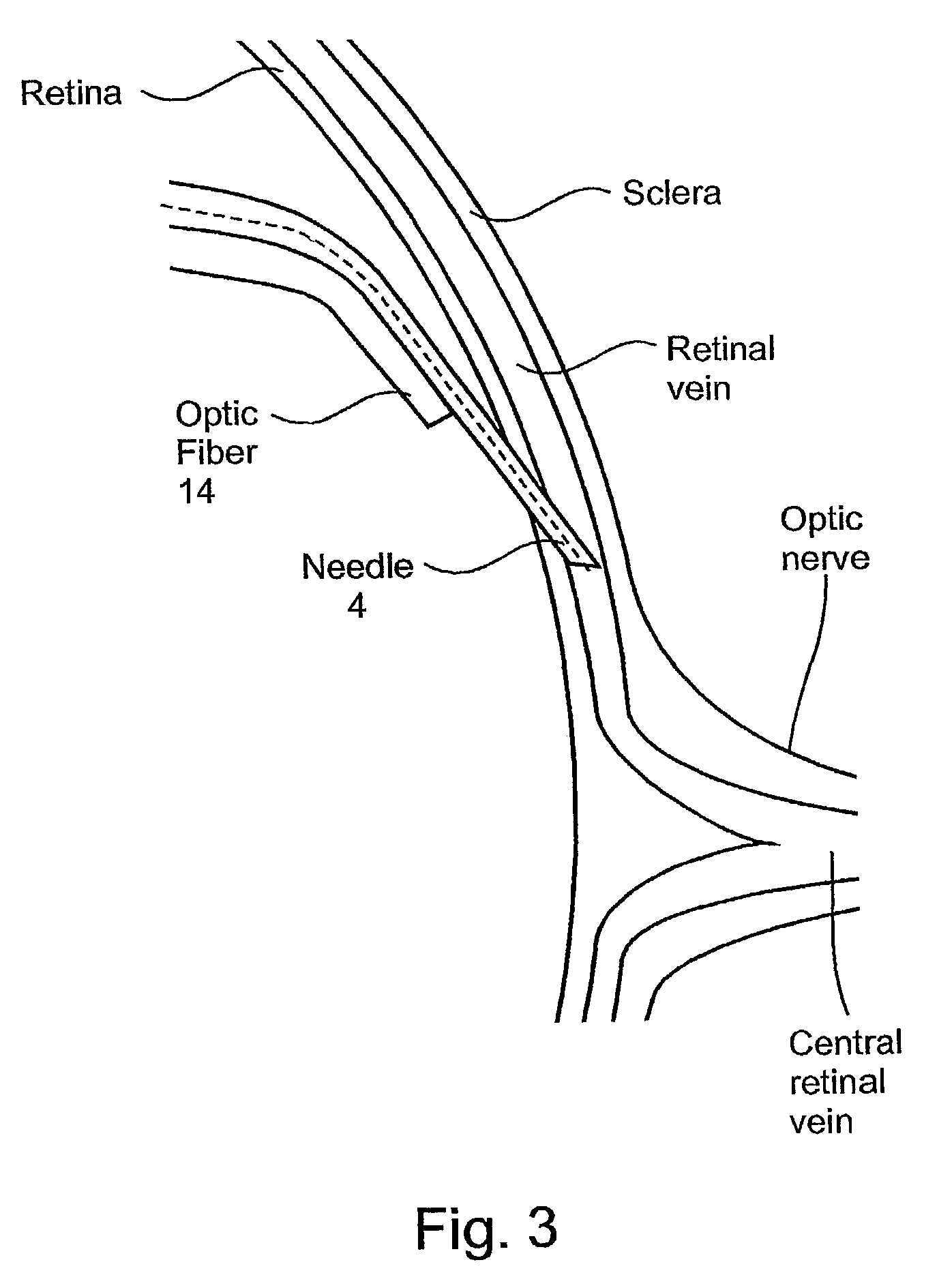 Microsurgical injection and/or distending instruments and surgical method and apparatus utilizing same