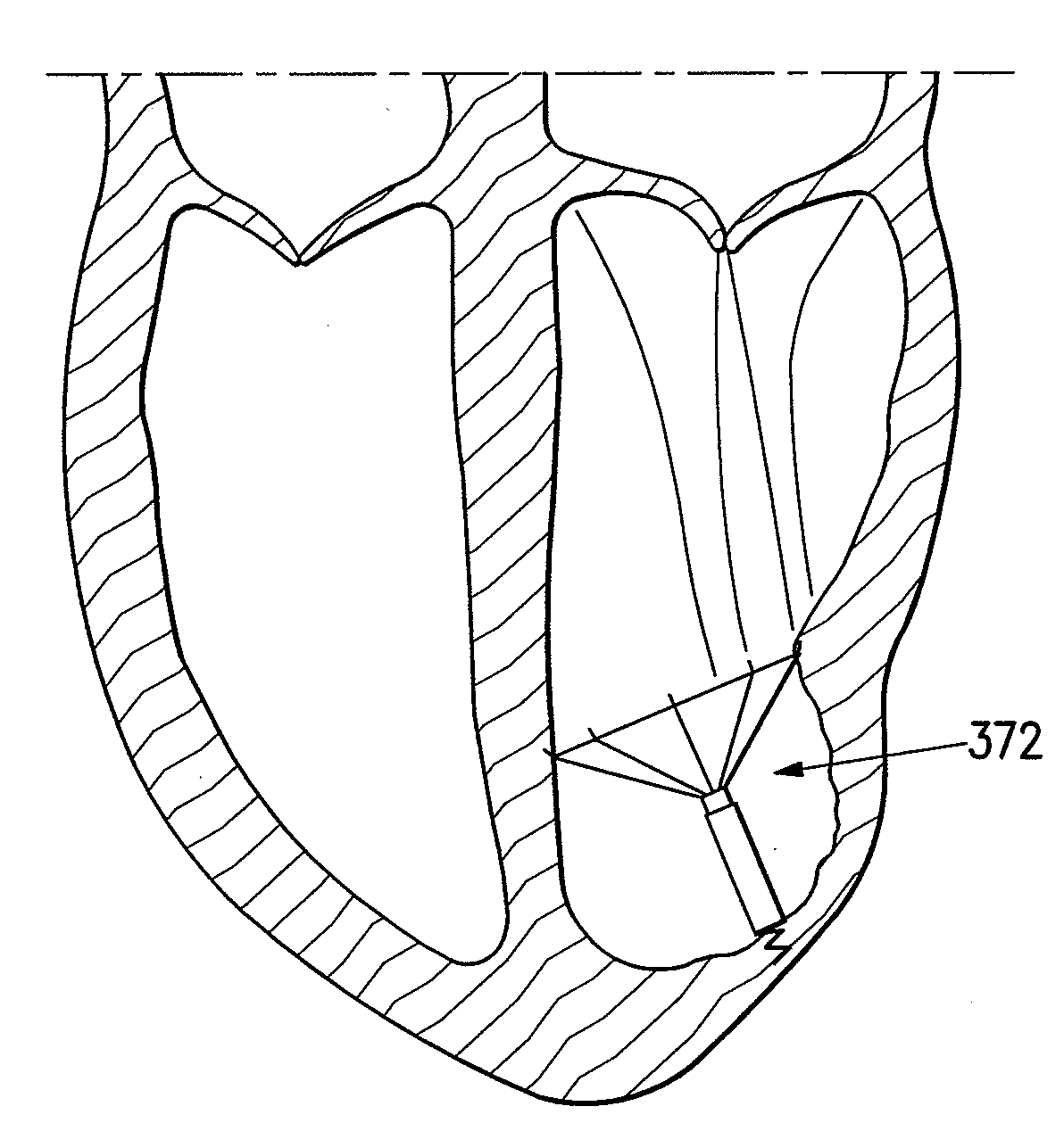 System for improving cardiac function