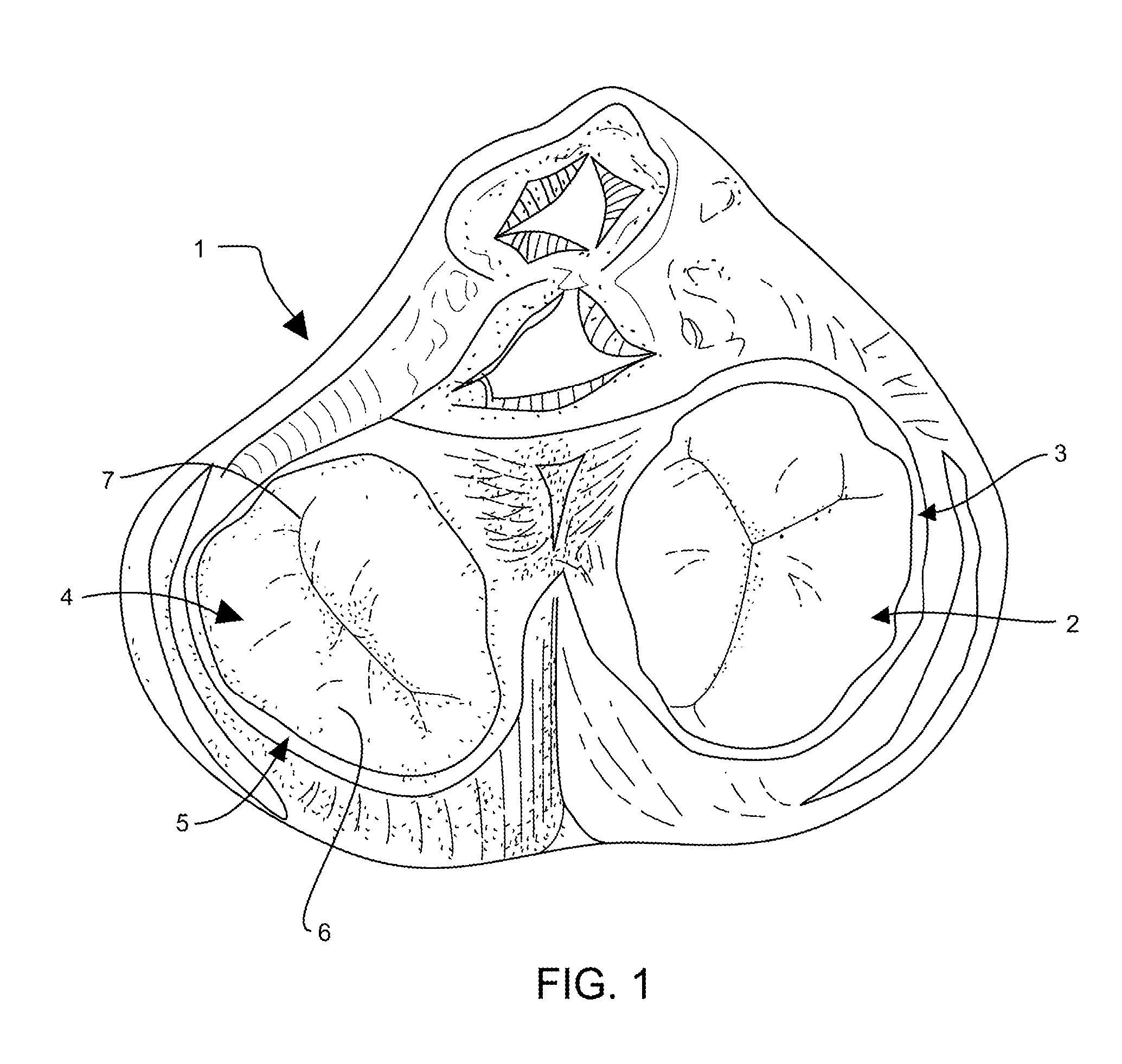 Annuloplasty Device Having Shape-Adjusting Tension Filaments