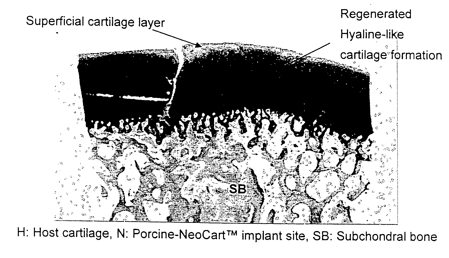 Method for in situ repair of injured, damaged, diseased or aged articular cartilage