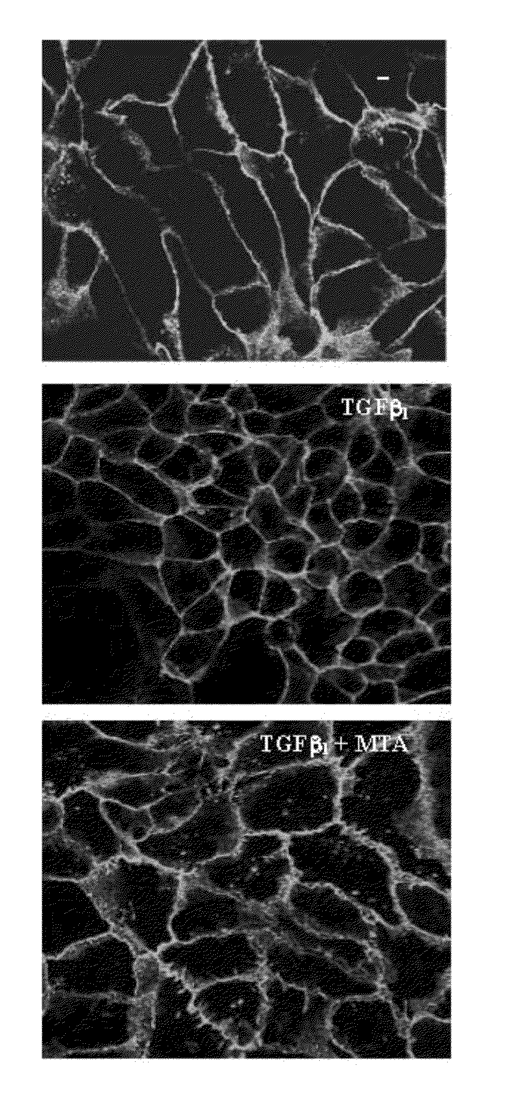 Compostions designed for the inhibition and/or blocking of the epithelial/mesenchymal transition