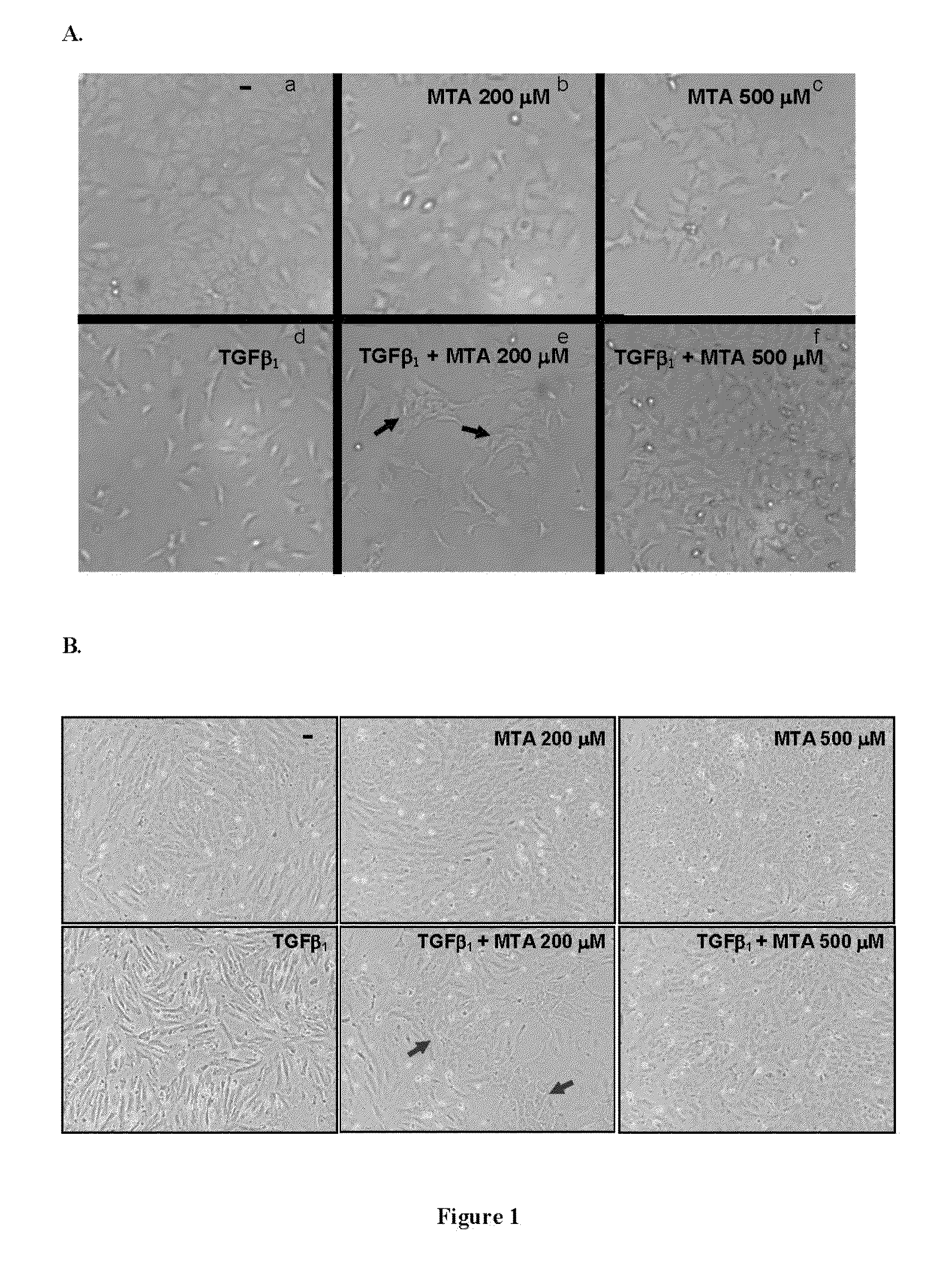 Compostions designed for the inhibition and/or blocking of the epithelial/mesenchymal transition