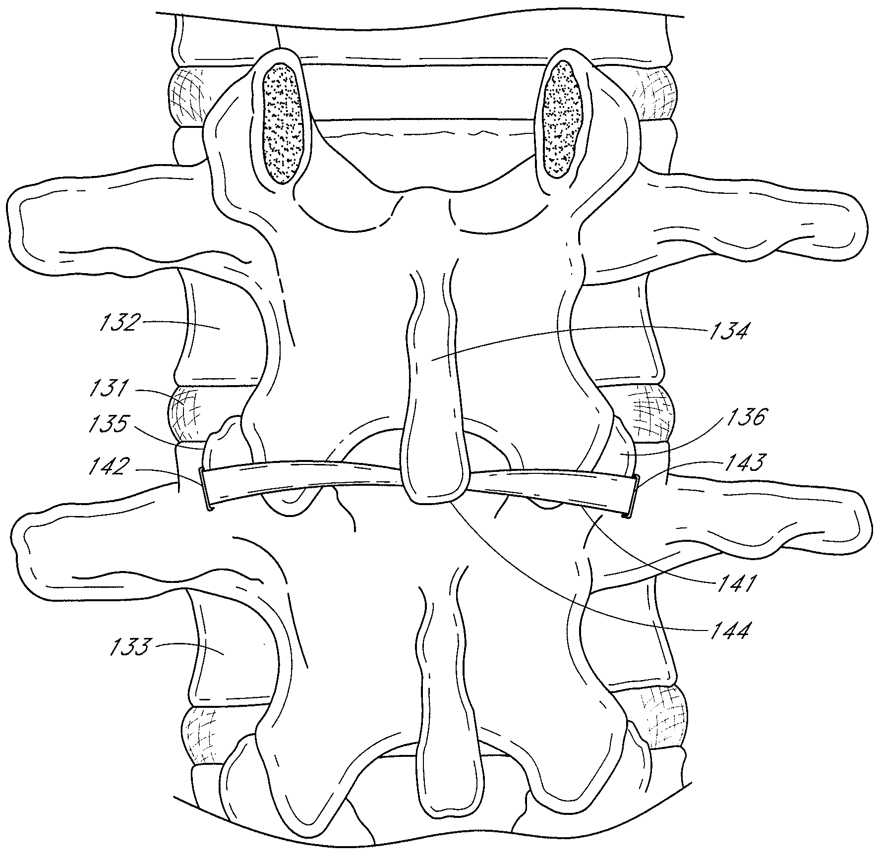 Methods, systems and apparatuses for torsional stabilization