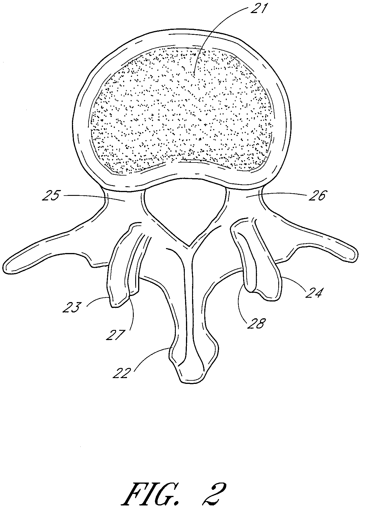 Methods, systems and apparatuses for torsional stabilization