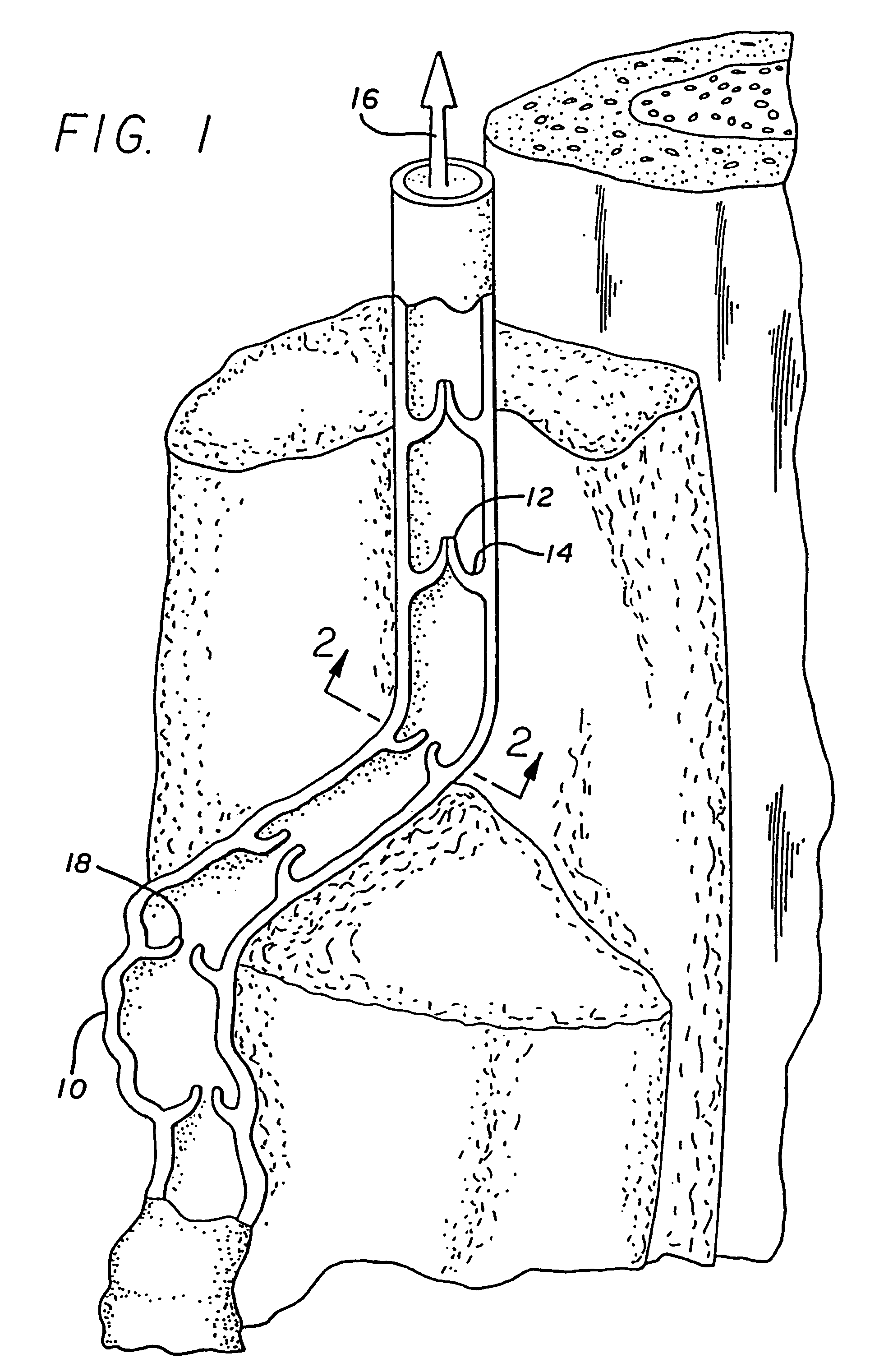 Method and apparatus for treating venous insufficiency using directionally applied energy