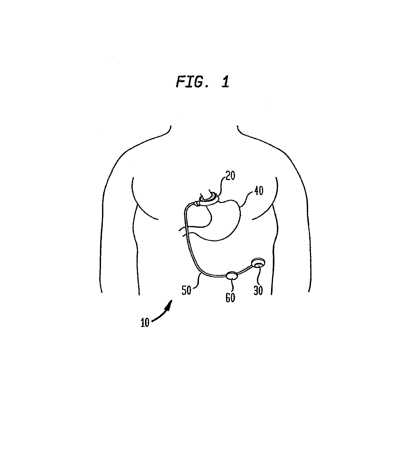 Powering implantable restriction systems using light