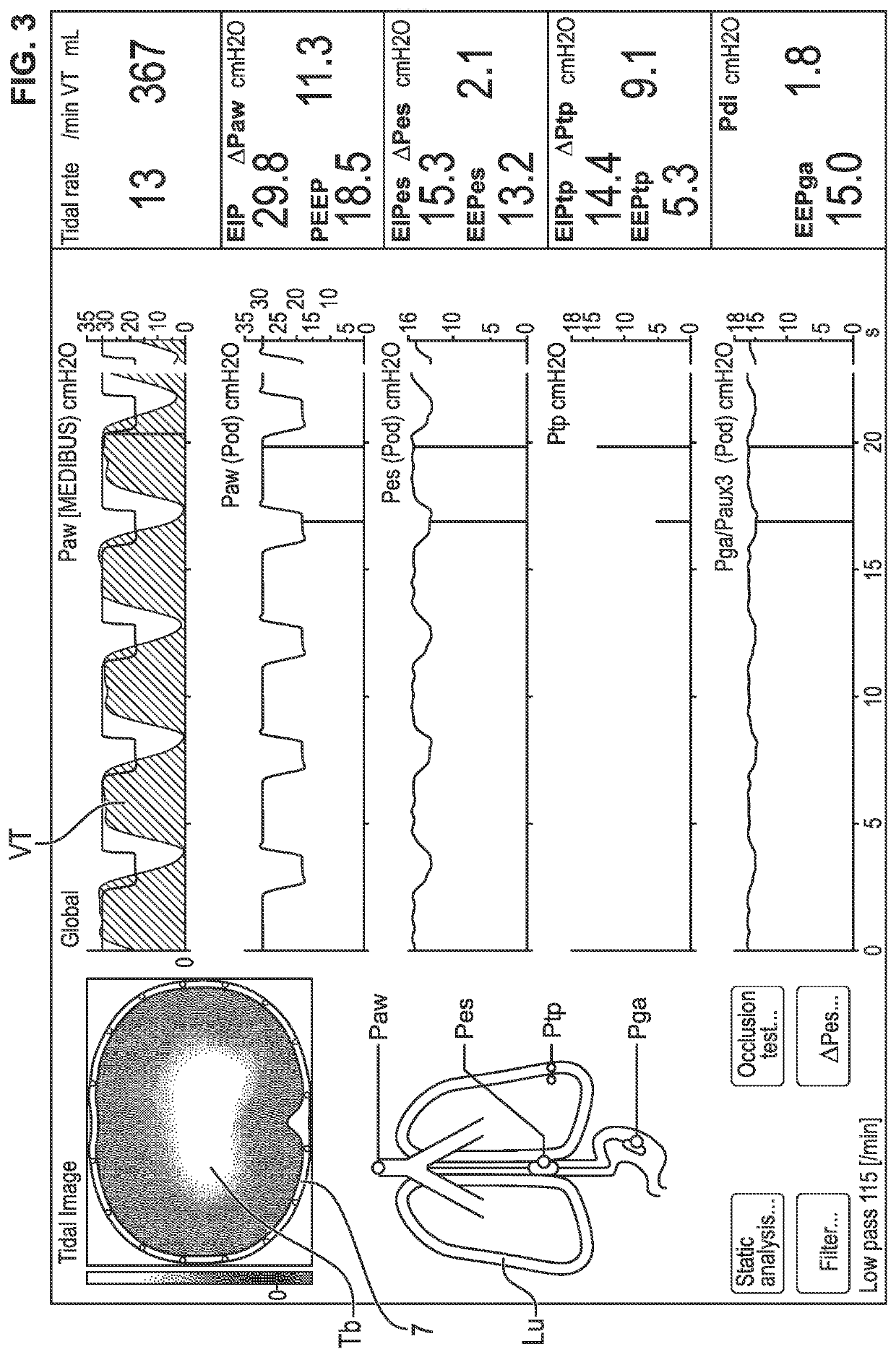 Device and process for measuring the lung compliance