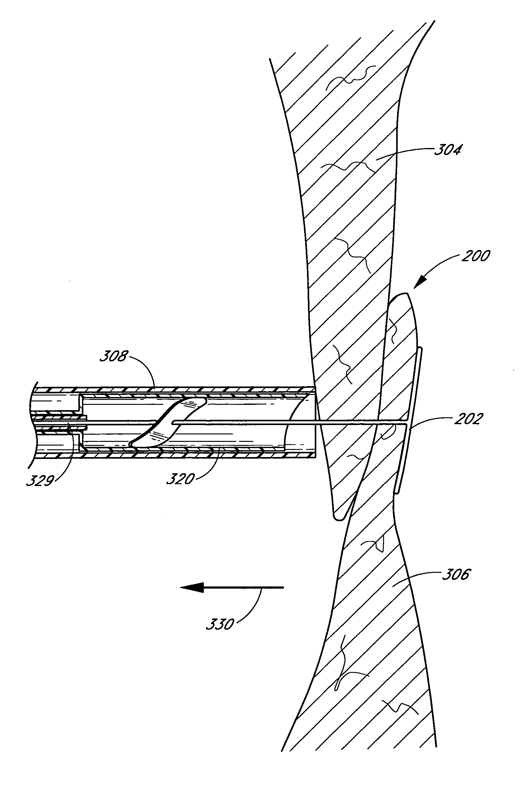 Patent foramen ovale closure system