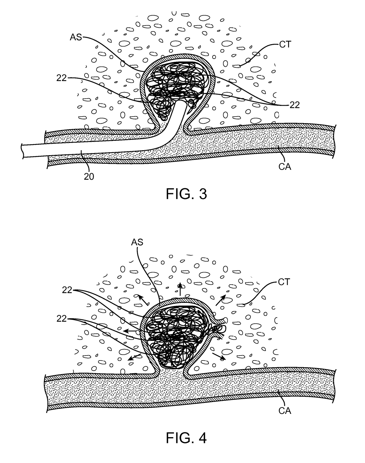 System and method for treatment of hemorrhagic stroke