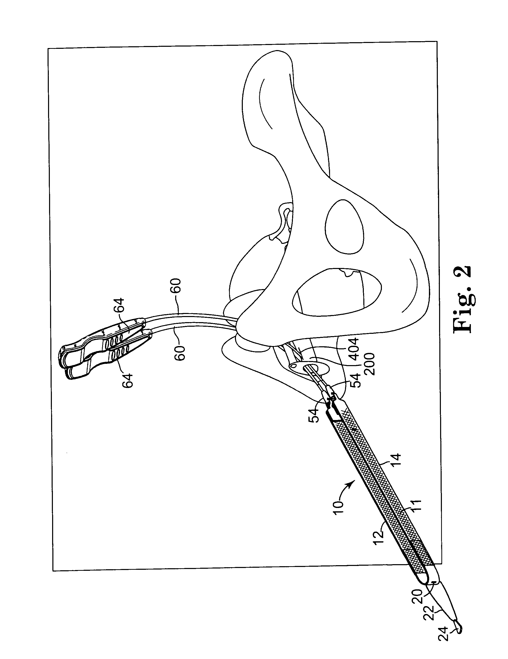 Surgical article and methods for treating female urinary incontinence