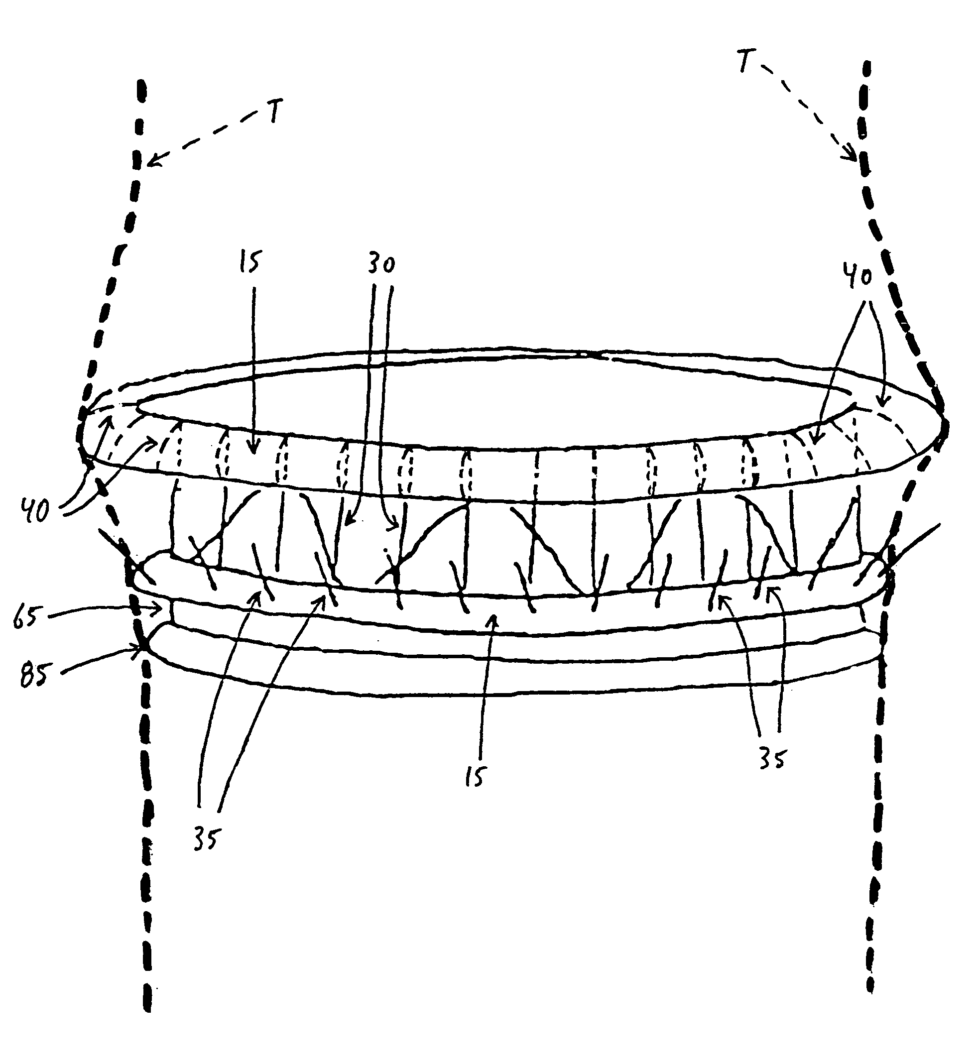 Fixation band for affixing a prosthetic heart valve to tissue