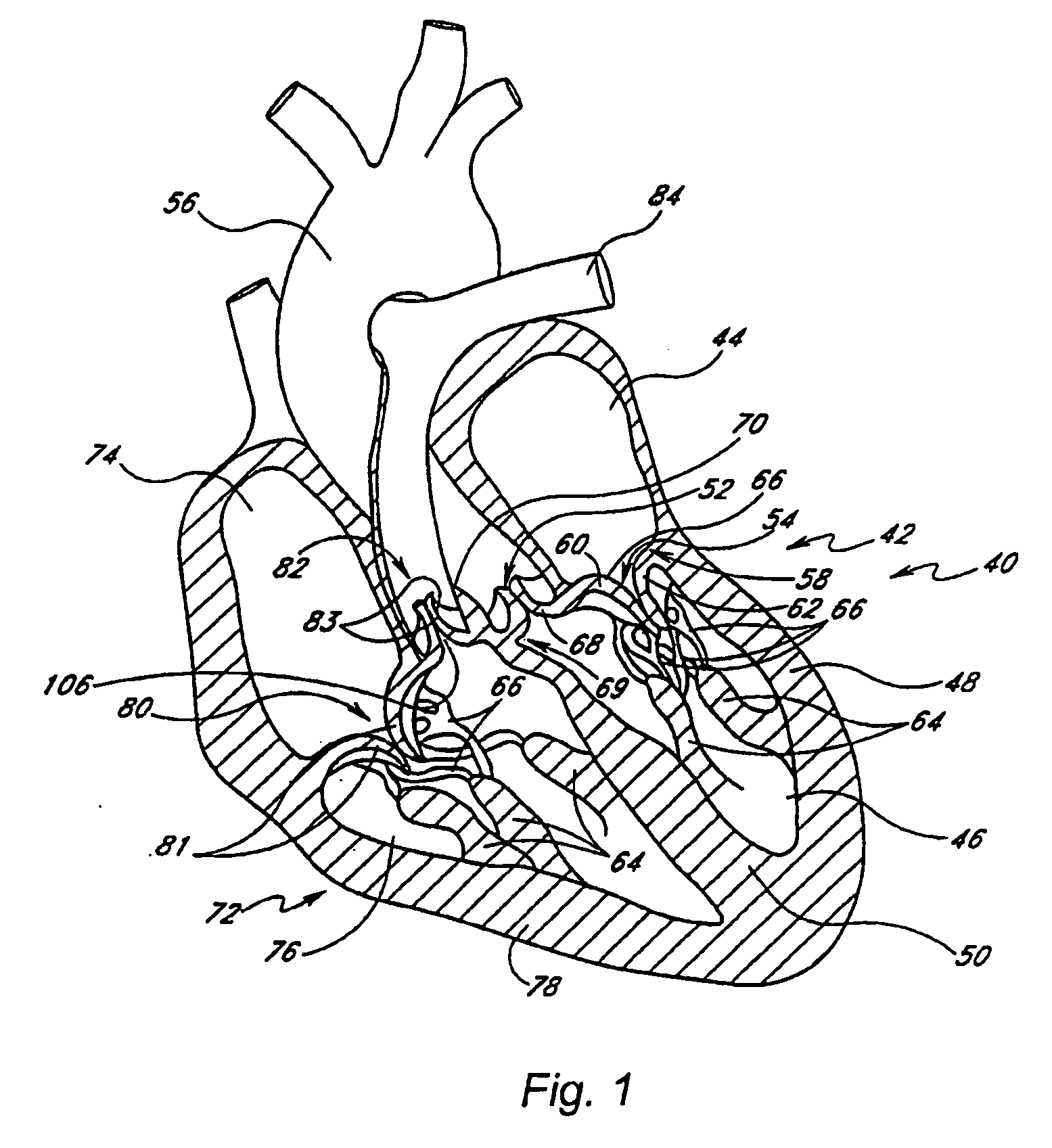 Prosthetic mitral valve